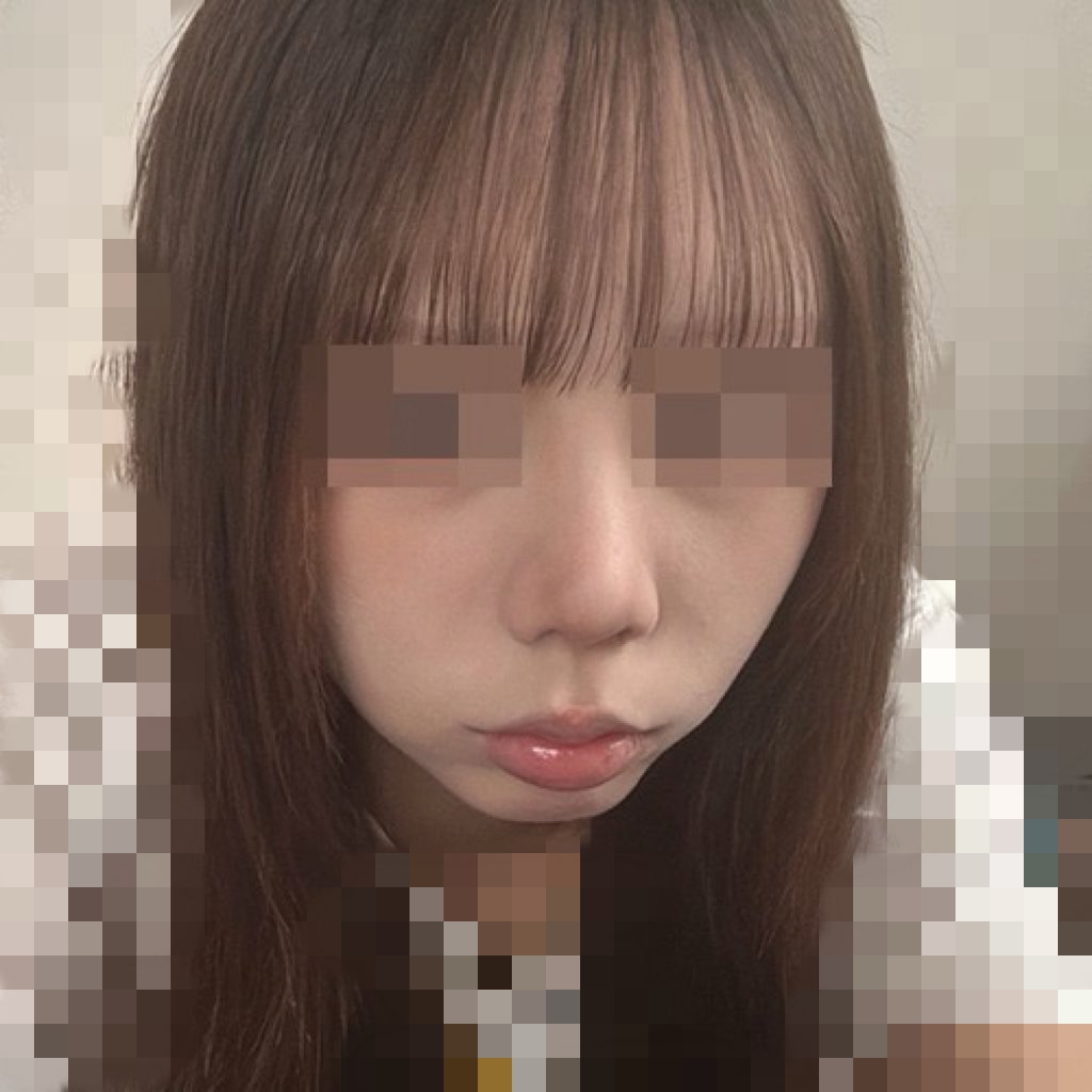 usa3fw's tweet photo. 🇰🇷韓国整形レポ🇰🇷

今回受けた施術は、小鼻縮小＋軟骨結び

執刀医【イム院長（イム・ジョンテク院長）】

術後は腫れは1週間程で落ち着いて、その後は若干の腫れ浮腫と黄色いアザくらいで日常生活には問題なし！
私はダウンタイム3週間✨️

📸術後１ヶ月

 #韓国ライズ整形外科 https://t.co/kX8Glttxyp