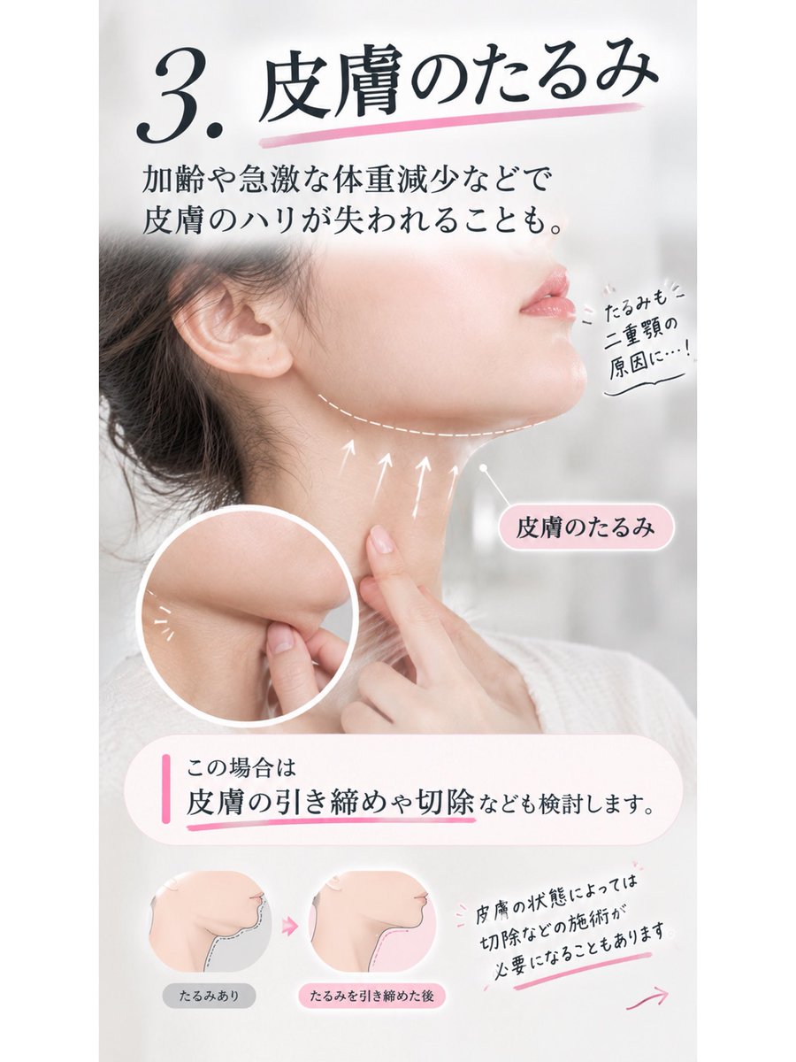 INDIBA_OnpaLabo's tweet photo. 「二重顎＝脂肪」だと思ってない？

実はここ、かなり重要です。

脂肪を取っても二重顎が残る場合、
原因は脂肪以外にある可能性も。

✔︎ あご下の脂肪
✔︎ 広頸筋のゆるみ
✔︎ 皮膚のたるみ

二重顎は「脂肪の量」だけで決まるわけではありません。 https://t.co/zh8qhjFN57