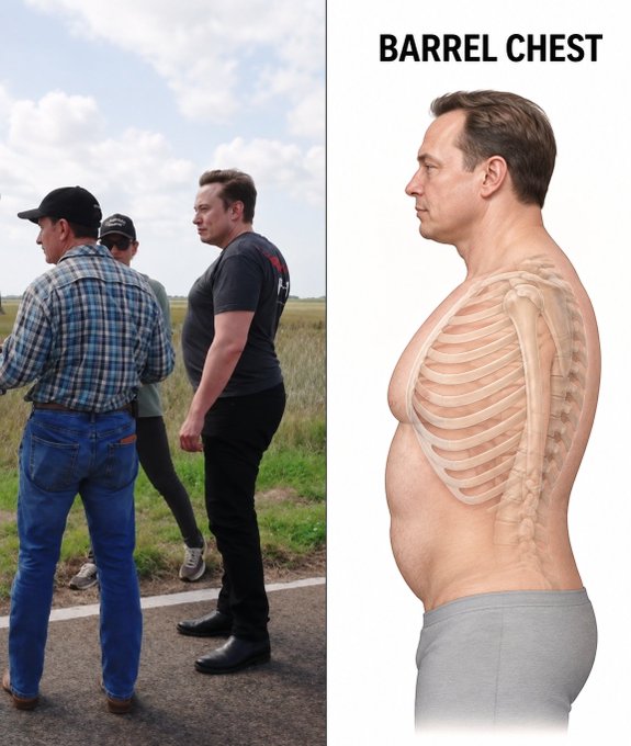 A side profile of Elon Musk in a tight black shirt showing his protruding chest is shown next to an anatomical illustration labeled "BARREL CHEST" depicting a man with a rounded, expanded ribcage, illustrating the user's question regarding the scientific basis for his distinctive barrel-shaped torso.