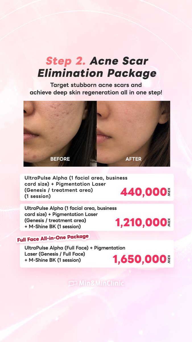 Minandmin_en's tweet photo. Want to erase scars &amp; pigmentation with massive October savings? 💫

Get up to 50% OFF + an extra 10% OFF for companion visits with our October All-in-One Event! Starting at a special price of 280,000 KRW~.

#MinAndMinClinic #MinAndMinScarLab #UltraPulse #ScarRemoval https://t.co/rVh8GUjxqr