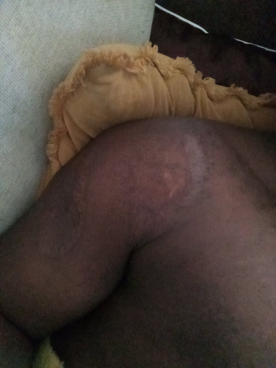 Lulekorg's tweet photo. @TwiceIsMore @ThembisileQ21 This scar I got burnt 1987 when they confronted that woman she took a pot of beans and threw it on me and my uncle got burn face and shoulder https://t.co/ZMdzZsZOFo