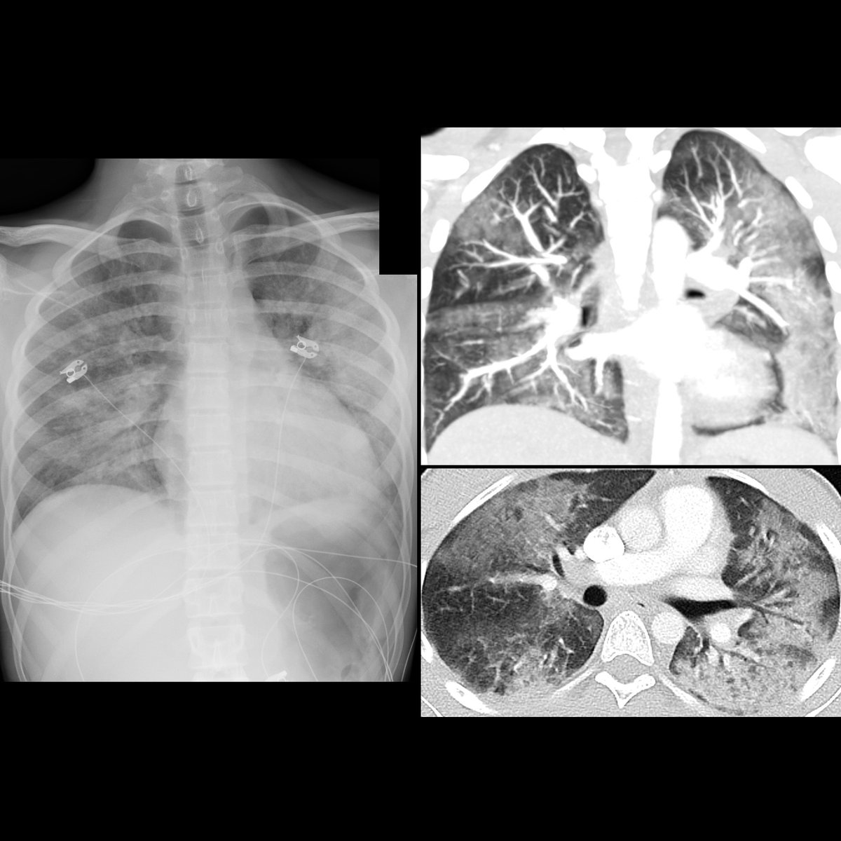 pedsimaging's tweet photo. Teen with respiratory distress who has history of vaping
CXR PA (left) shows bilateral ground glass opacities that are more basilar than apical in nature+which are more prominent on left than on right
#FOAMed #MedEd #FOAMRad #PedsRad #RadEd #radiology #pediatrics #radiologia https://t.co/9qxCNhL4VW
