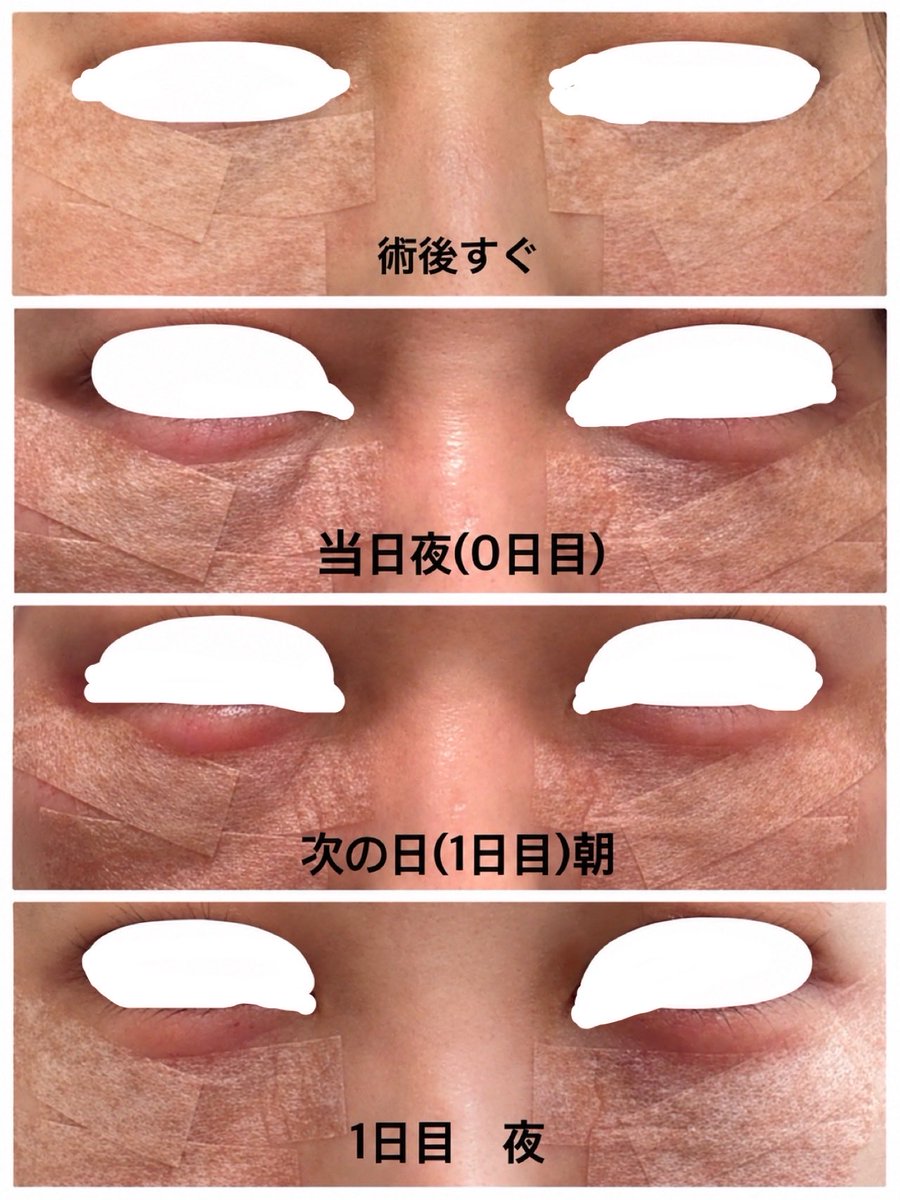 funuta_biyou's tweet photo. ◆大満足の裏ハムラレポ

※手術当日を0日としてカウントしています。

社畜のワシは3連休だけとり、いざ挑戦。

【執刀医　アマソラ　赤嶺先生】

・当日(0日目)〜
電車で帰宅。
たまに流れる血の涙を無の心でティッシュで拭きながら帰宅。
黒いマスクにしてなかったらマスクが血で染まっていたと思う。オススメ。
夫に「万華鏡写輪眼(NARUTO)使ったの？」と言われる。
痛み止め飲めば全然耐えられる痛みで、家事もできちゃう。

・1日目〜2日目
もう出血はしない。
パンパンに目を殴られたみたいに腫れて、涙袋も赤くなり、内出血も化粧で全く隠せない。メヤニがすごい。

目周りだけじゃなく下顔面も別人のように腫れてアンパンマン！20キロ太った顔を疑似体験。
夫には「知らない人が家にいるみたい」と人見知りされて、目を合わせてもらえなくなる。
もう痛み止め飲まずに余裕に過ごす。

・3日目〜
ここから出勤。
だいぶ人の顔に戻り、メイク・マスク・大きめメガネで誤魔化せるようになったが、職場の人やお客様からも10日目くらいまで「なんか目腫れた？」と言われる。
美容好きがいない職場だから、ばい菌が入ってものもらいが腫れちゃって〜と誤魔化す。笑

痛みは想像以上に余裕✌️だったが、目の下は触ると当然痛い。メイク落とし、スキンケアや日焼け止め塗るのをソフトタッチで塗るのが大変だった。

3ヶ月くらい経つともう最後に載せたafter写真くらいには綺麗になっていた。
マスクなしで周りにばれなくなるのは最低2週間は必要かな、という印象。

結果！最高！本当にやってよかった！

意外と一番辛かったことは、コンタクトを術後一週間禁止されたこと。365日コンタクトで、ど近眼の私には辛すぎた。
手術の何ヶ月か前から週に何回かはオシャレメガネで出勤して、メガネどうした？と注目されないように、周りの目を慣れさせといた。

一重や、薄い唇などはセクシーだったり(若い頃の田中裕子とか、女優のりょうとか大好き、、、)、顔の造形は人それぞれ、個性や美しさがある。
でも、ニキビ、肌荒れ、くすみ、シミ、クマはあって魅力的なことは少なからずないんじゃないかと個人的には思うので、私はこれらは全勢力をかけて駆逐していこうと思っている。

小学生の時からコンプレックスだったクマ。
人生を変えてくださった先生に感謝でいっぱい。