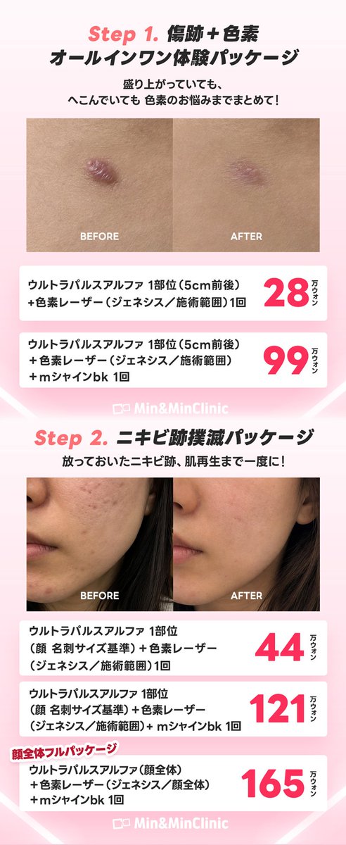 Mnmclinic_jp's tweet photo. 10月限定✨
ボディ＆フェイス 傷跡ケアイベント！

傷跡・色素・ニキビ跡から
ボトックス＆フィラーまでまとめて特別価格に。

📅 期間：10/1〜10/31

🎁 先着30名様
施術を受けた方にSRBクリームまたはSRBローションを1つプレゼント！

【傷跡＋色素】
・ウルトラパルスアルファ 1部位（約5cm）＋ジェネシス 1回
28万ウォン

・上記＋MシャインBK 1回
99万ウォン

【ニキビ跡】
・ウルトラパルスアルファ 1部位（顔・名刺サイズ）＋ジェネシス 1回
44万ウォン

・上記＋MシャインBK 1回
121万ウォン

・顔全体フルパッケージ
ウルトラパルスアルファ＋ジェネシス＋MシャインBK 1回
165万ウォン

【ボトックス＆フィラー】
・ボトックス 50％OFF
・フィラー 50％OFF

👭 家族・友達と一緒なら
2名 22.5％OFF
3名 25％OFF
4名以上 27.5％OFF

※イベント外施術30万ウォン以上のお支払いが条件
※イベント施術・パッケージは1つのみ選択可能
※追加施術・追加容量は通常料金
※他イベントとの併用不可

#ダブルM 
#韓国クリニック 
#韓国肌管理 
#ニキビ跡治療 
#色素レーザー