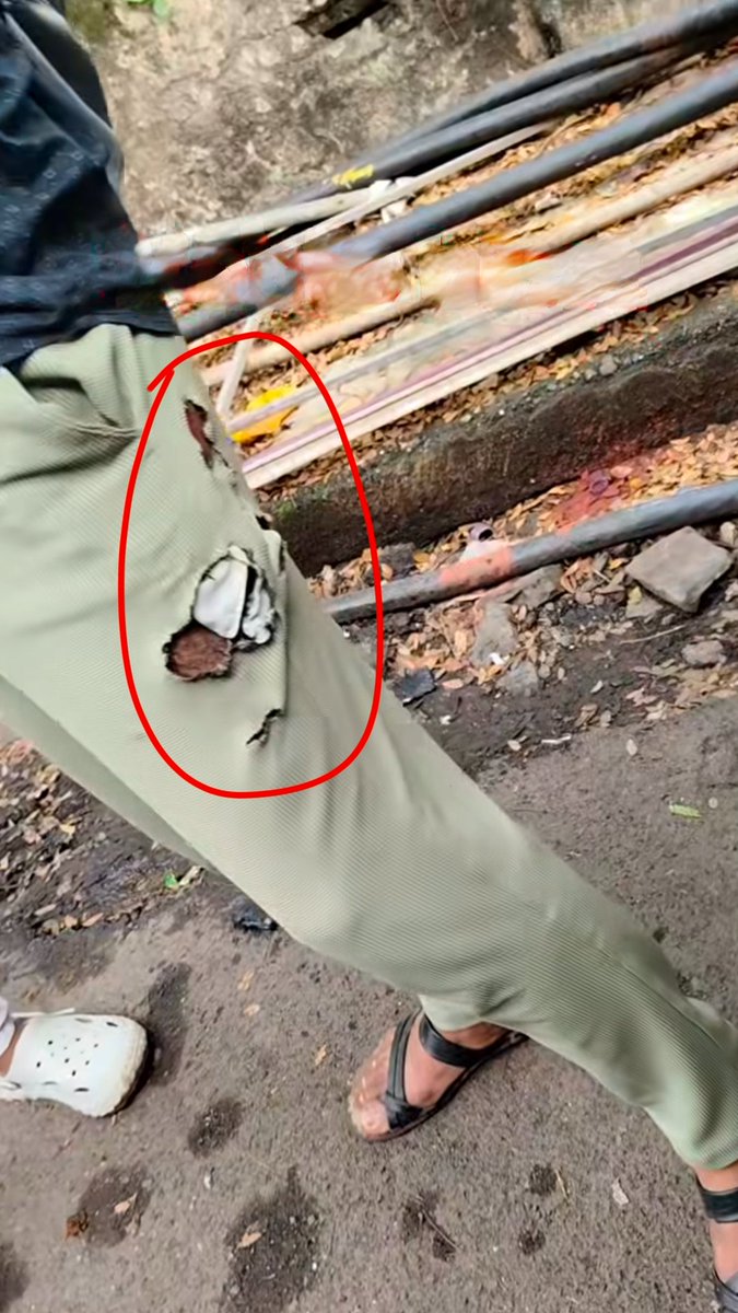 Miss_Soumya56's tweet photo. This boy purchased a OnePlus Lite mobile phone for ₹17,000 about two months ago.

Yesterday afternoon, in temperatures around 40°C, he was playing Free Fire on his mobile phone.

After playing the game, as soon as he put the mobile phone in his pocket, it suddenly exploded within a short time.

The boy says that if this incident had happened while he was talking on the phone while holding it to his ear, it could have caused serious damage.

People pay ₹2–4 thousand extra to buy a mobile phone from a branded company to ensure security and assurance against such incidents.

If any manufacturing or battery-related defect is found in the incident, the company should investigate it seriously and take appropriate action.