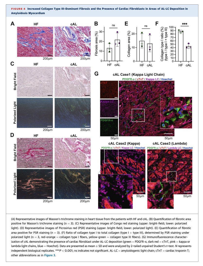 Myeloma_Doc's tweet photo. #Myeloma Paper of the Day: Transcriptome analysis of AL #amyloidosis pt myocardial samples finds upregulation of fibroblast activation genes (e.g. collagen type I/III & periostin), fibroblast-to-myofibroblast transition in vitro & matrix remodeling: https://t.co/re73ymwdq3. #alsm https://t.co/R4Fj3m0eGs
