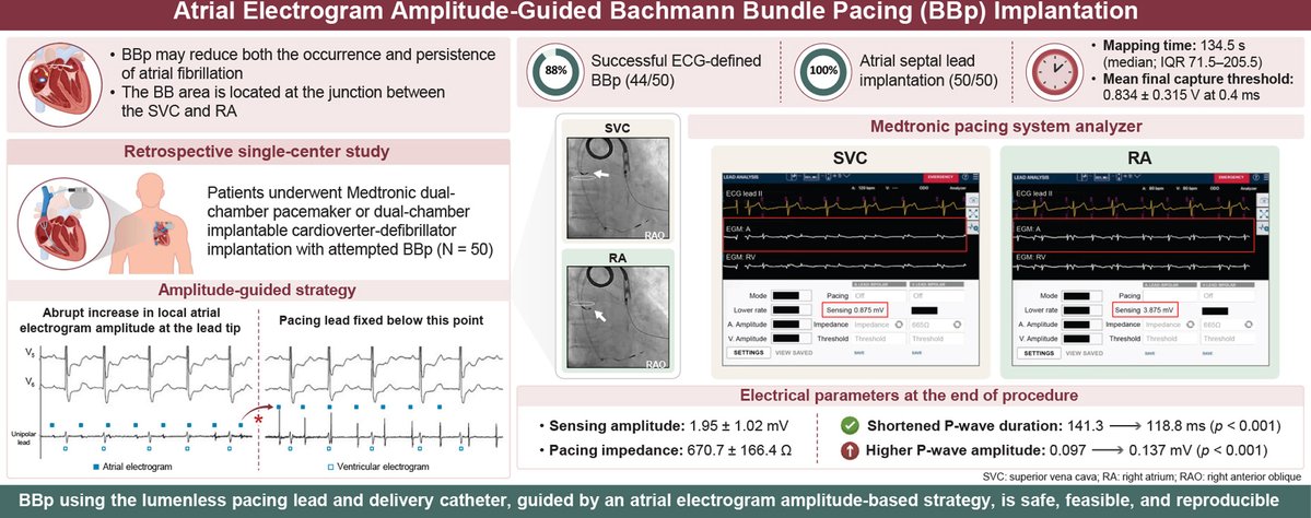 HRS_O2Journal's tweet photo. Atrial electrogram amplitude–guided Bachmann bundle pacing implantation: A single-center experience
#EPeeps
https://t.co/nGRKaRqYFE https://t.co/VmxZzkcYXz