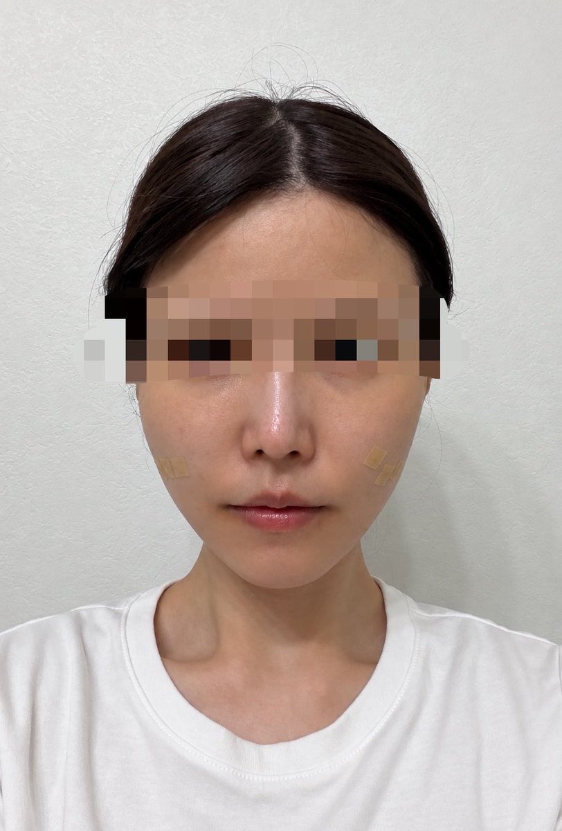 hana___24_'s tweet photo. 【当日／before → after】
リティング美容外科釜山院（＠liting_japan）🏥で糸リフトをしていただきました♩
人生初釜山でしたが福岡からこんなに近いとは思わず本当にびっくり！！！！
術後なのでまだ腫れてますが、既に法令線が薄くフェイスラインも綺麗になってる
🥲♡
リプに続きます↓ https://t.co/Z1FUzveaXB
