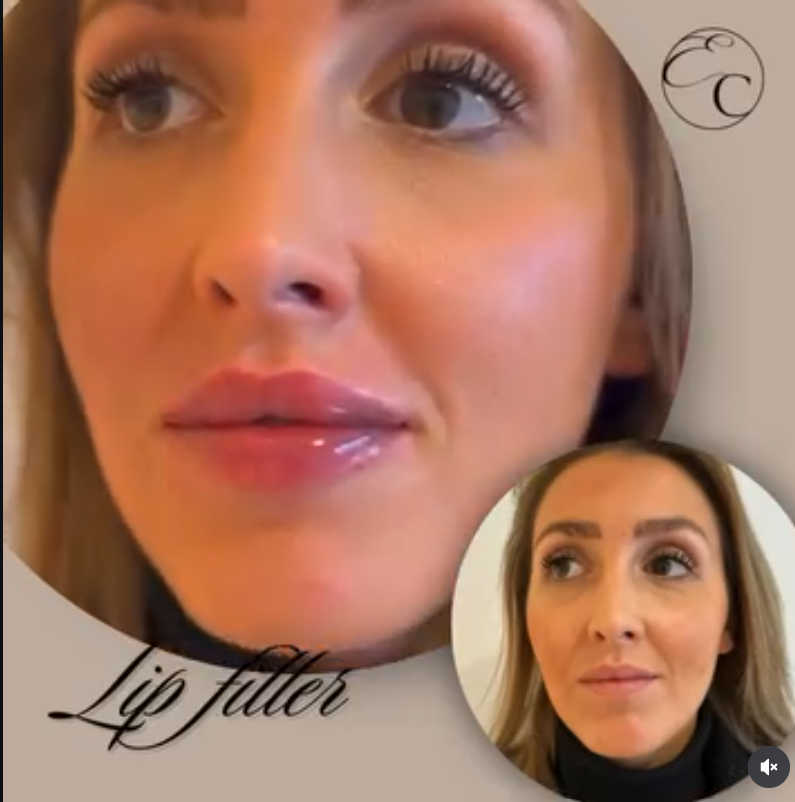 EnhanceClinicBe's tweet photo. 𝐋𝐢𝐩 𝐟𝐢𝐥𝐥𝐞𝐫 👄

1ML Lip filler for this beautiful lady!
Visit: https://t.co/XeHtd8yKsi
🕣 Appointment time: 20 min
🤕 Downtime: Bit of swelling and bruising can accur, allow two weeks to fully settle.

#enhanceclinic #aesthetic #ghent #botox #beauty #fillers #skincare https://t.co/f8SDHnIrv2