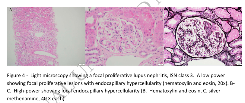 NDTsocial's tweet photo. Protocol kidney biopsy in the management of proliferative (class III/IV) lupus nephritis: barking up the wrong tree!

https://t.co/TQzJcnKbJv https://t.co/faihIPXI6V