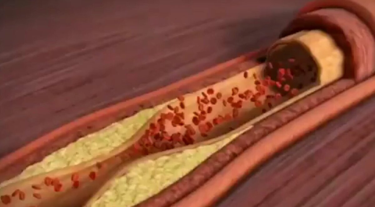 thisispeak007's tweet photo. French people eat high-cholesterol foods daily yet have lower heart disease than Americans.

We avoid cholesterol and our hearts are faring worse.

Their secret?

The part of what American experts recommend we skip: https://t.co/3YR8T9ImfQ