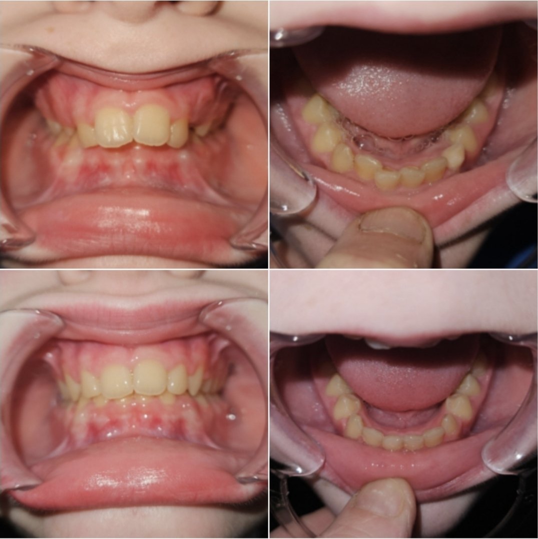 Beth33374166's tweet photo. I was about to spend $6k on braces for my son and he'd have to wear them for 3 years.
I decided there had to be an alternative.
I found Toothpillow and this is after 11 months of only nightwear with zero pain involved.
His dentist says he will no longer need braces. 🤗 https://t.co/O6LXEaWkBF