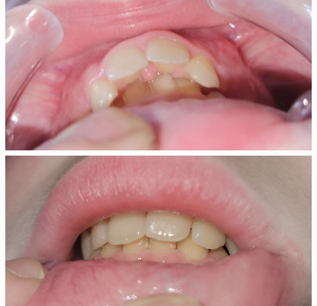 Beth33374166's tweet photo. I was about to spend $6k on braces for my son and he'd have to wear them for 3 years.
I decided there had to be an alternative.
I found Toothpillow and this is after 11 months of only nightwear with zero pain involved.
His dentist says he will no longer need braces. 🤗 https://t.co/O6LXEaWkBF