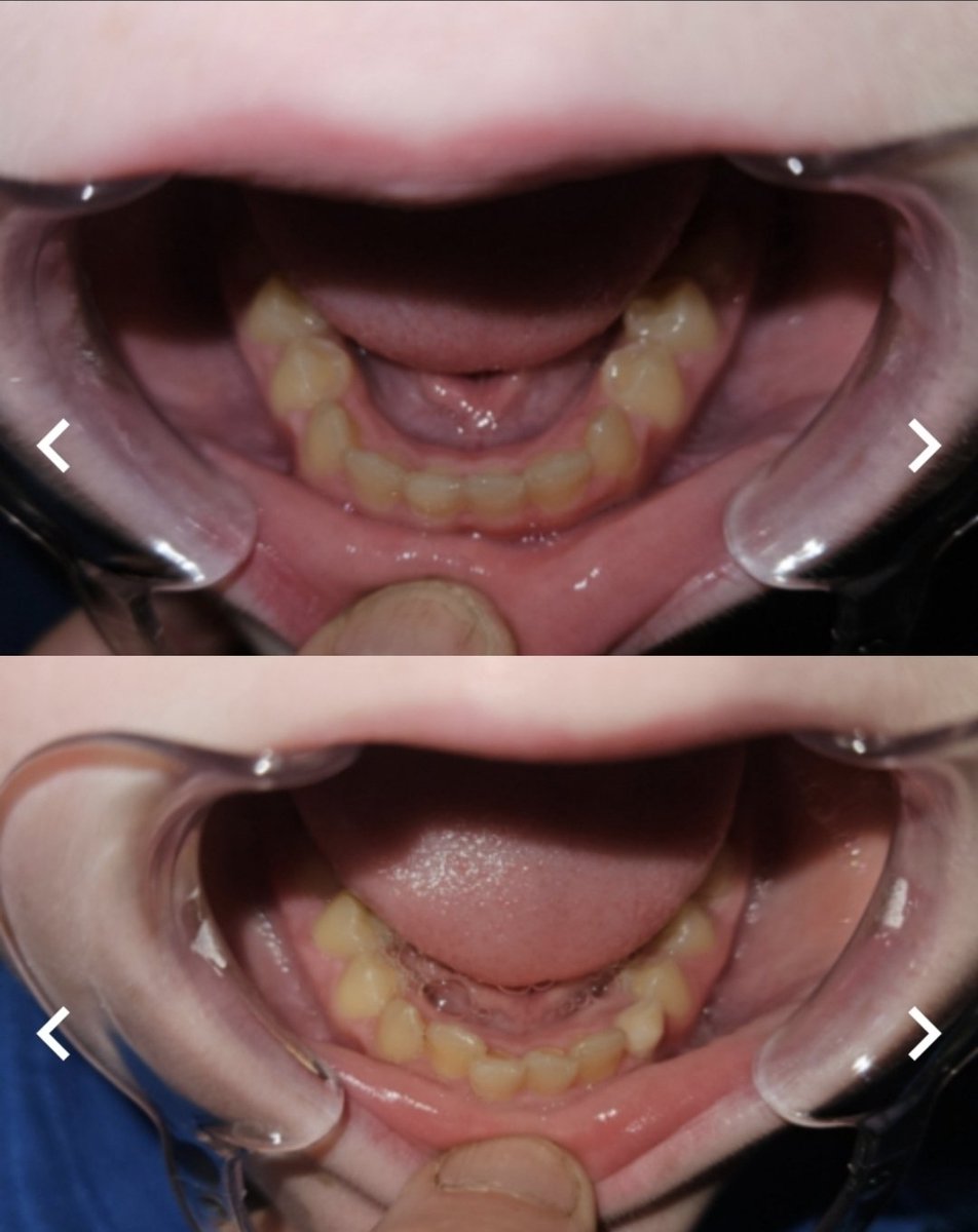 Beth33374166's tweet photo. I was about to spend $6k on braces for my son and he'd have to wear them for 3 years.
I decided there had to be an alternative.
I found Toothpillow and this is after 11 months of only nightwear with zero pain involved.
His dentist says he will no longer need braces. 🤗 https://t.co/O6LXEaWkBF
