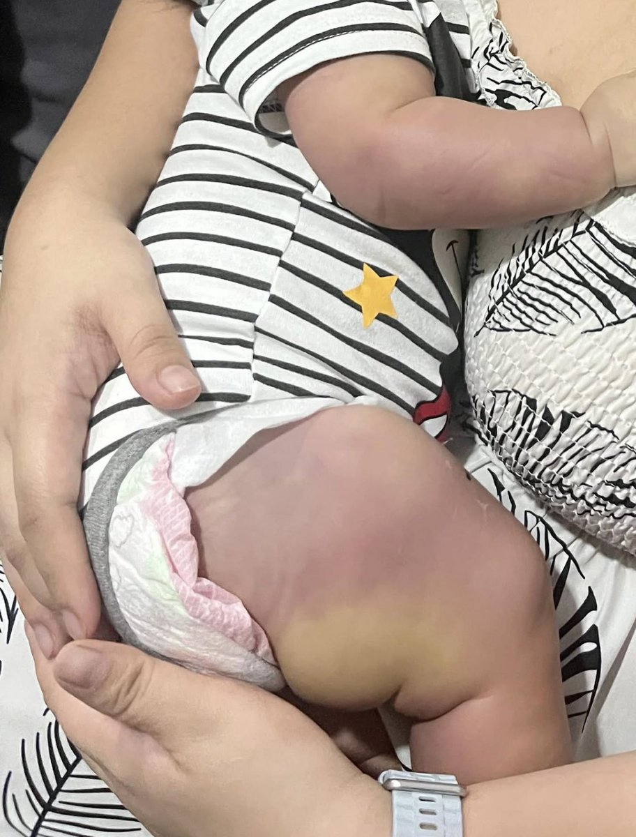 toobaffled's tweet photo. AWARENESS: A BABY DIED HOURS AFTER VACCINATION — THE FAMILY WANTS ANSWERS

A 2-month-old baby was reportedly healthy and had no fever, cold or other obvious illness before being taken to a health centre in Harmony Hills 1, Muzon, San Jose del Monte, Bulacan.

According to the family, the baby received vaccinations at the centre.

Hours later, their baby was dead.

The family says they are not claiming to have all the answers. They are asking the questions that any grieving parent would ask:

What happened?

Why did a previously healthy infant deteriorate so rapidly?

The family says the baby’s leg was severely swollen after the vaccination and is asking the Philippine Department of Health, local health authorities and Raffy Tulfo in Action to investigate what happened.

This isn’t about declaring a cause of death before the evidence is available.

It’s about not dismissing a parent’s questions.

When an infant dies only hours after a medical intervention, the answer shouldn’t be “don’t ask questions.”

The answer should be:

Investigate. Document. Examine the medical records. Establish the cause.

Because whatever the final finding is, parents deserve the truth.

And if there is a problem that needs fixing, finding it could potentially protect another family from experiencing the same tragedy.

💔 A grieving parent deserves answers - not silence.