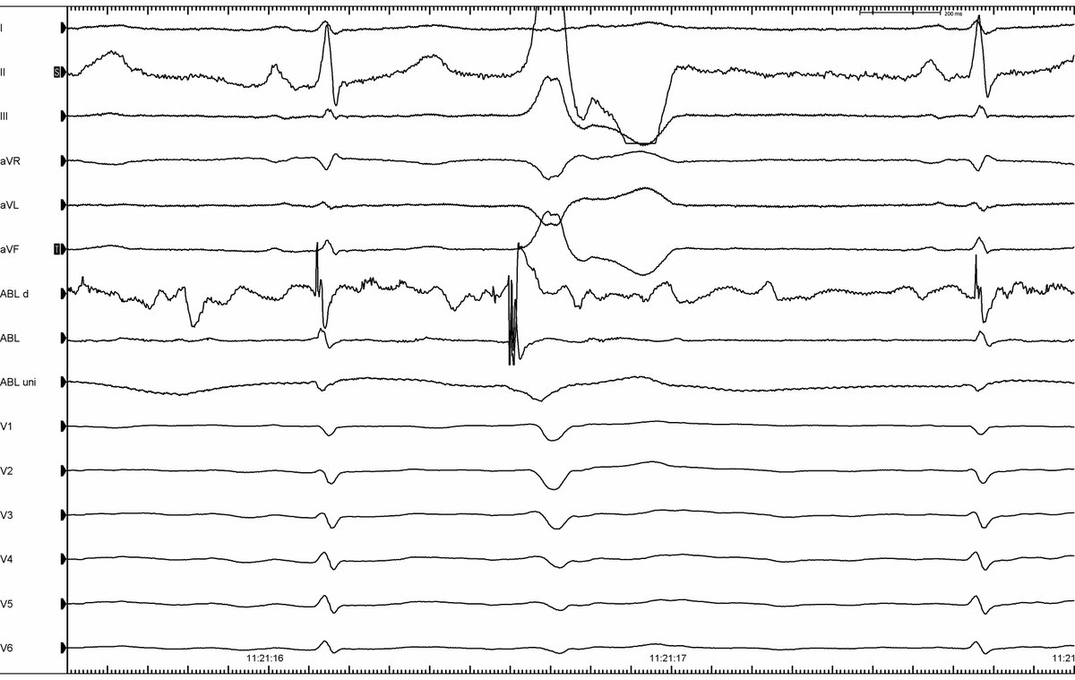 assurdani's tweet photo. From the earth to the moon: my first experience in the ventricle.
RVOT #CPVablation https://t.co/mj2QPhxerg