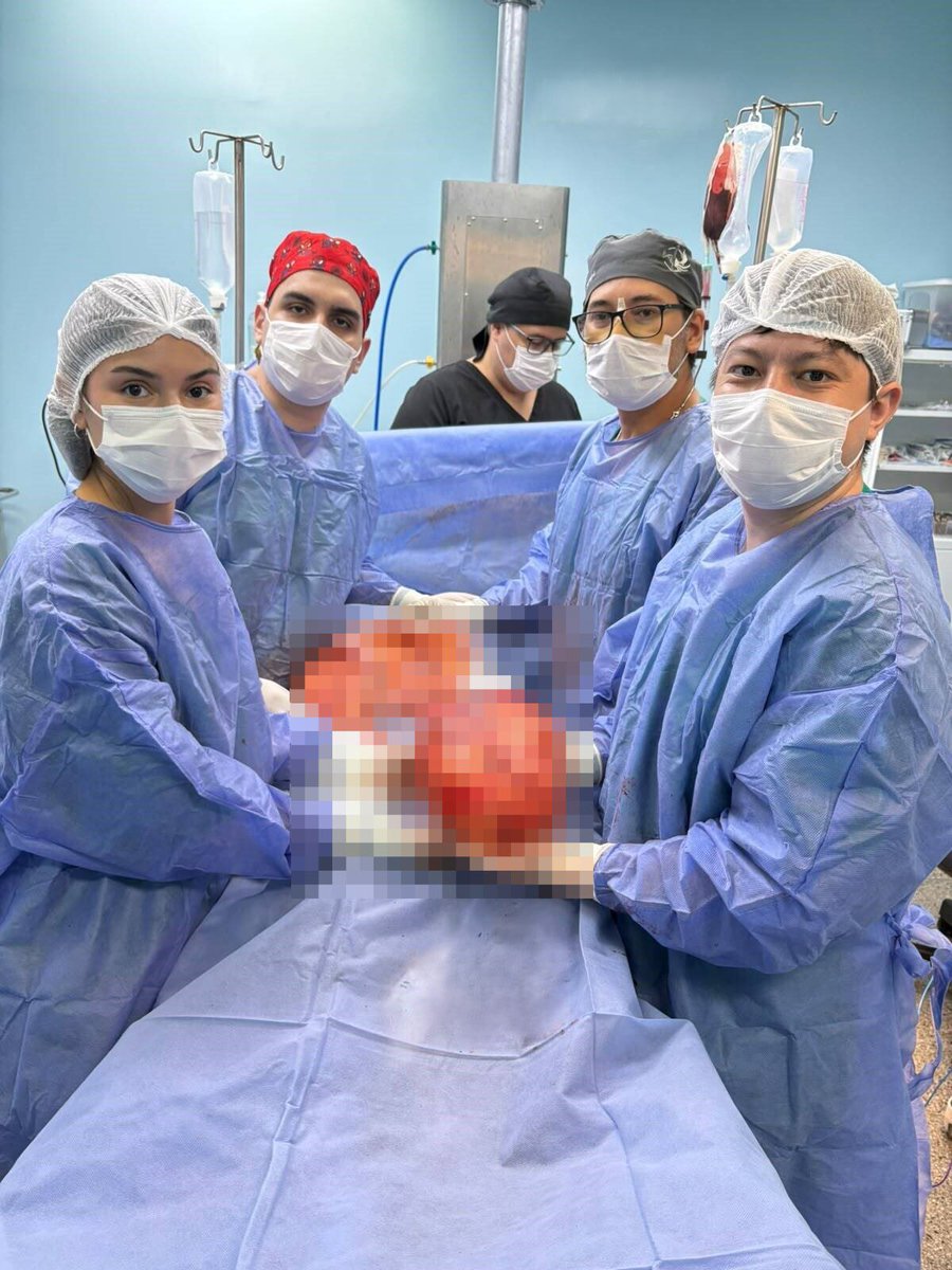IPSParaguay's tweet photo. 🏥 IPS Ciudad del Este extirpa tumor retroperitoneal de 14 kilos mediante cirugía de alta complejidad.
🔗 Leer más: https://t.co/kNt3wcUkPM https://t.co/4NY6YYPWy3
