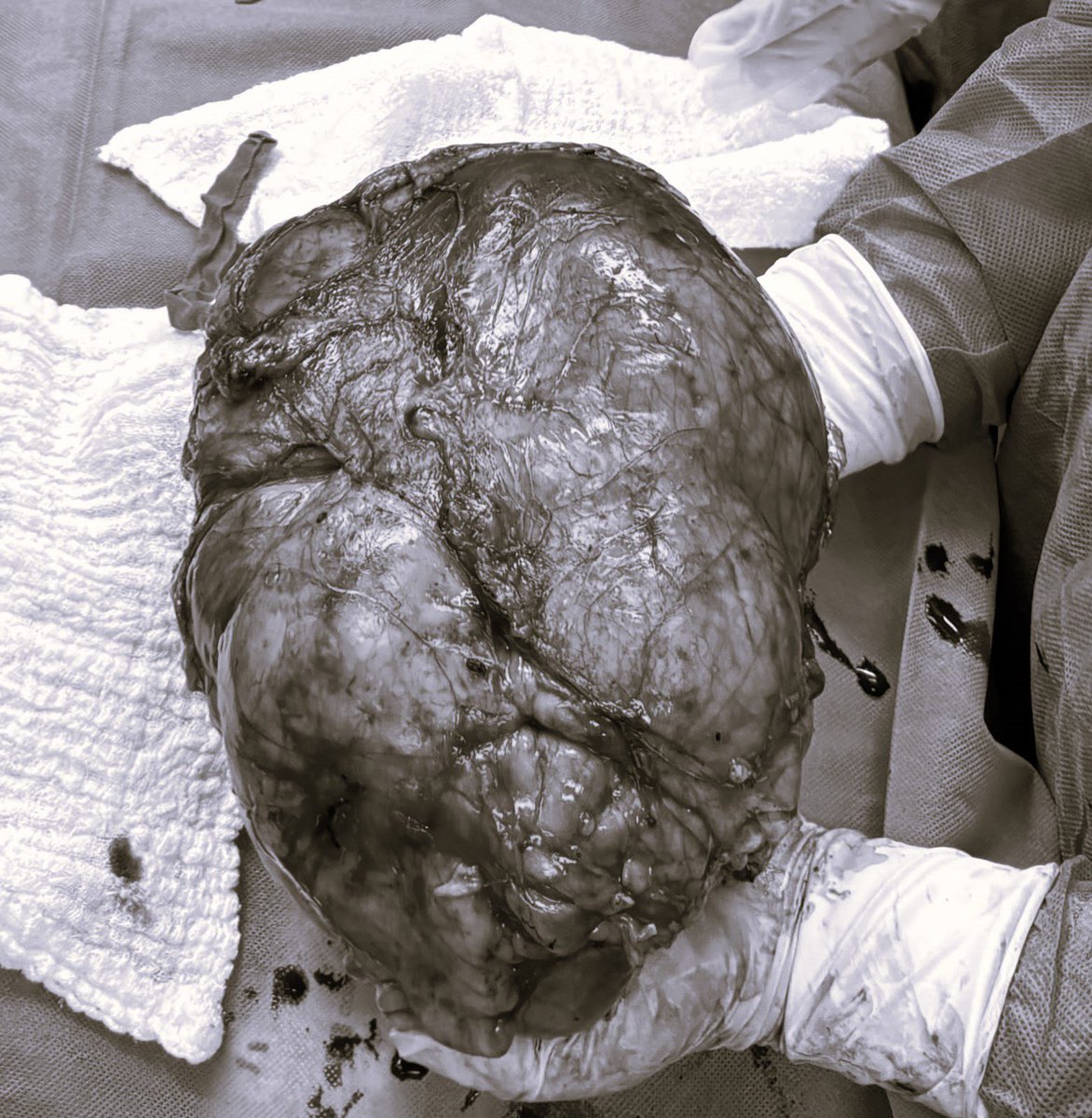 IPSParaguay's tweet photo. 🏥 IPS Ciudad del Este extirpa tumor retroperitoneal de 14 kilos mediante cirugía de alta complejidad.
🔗 Leer más: https://t.co/kNt3wcUkPM https://t.co/4NY6YYPWy3