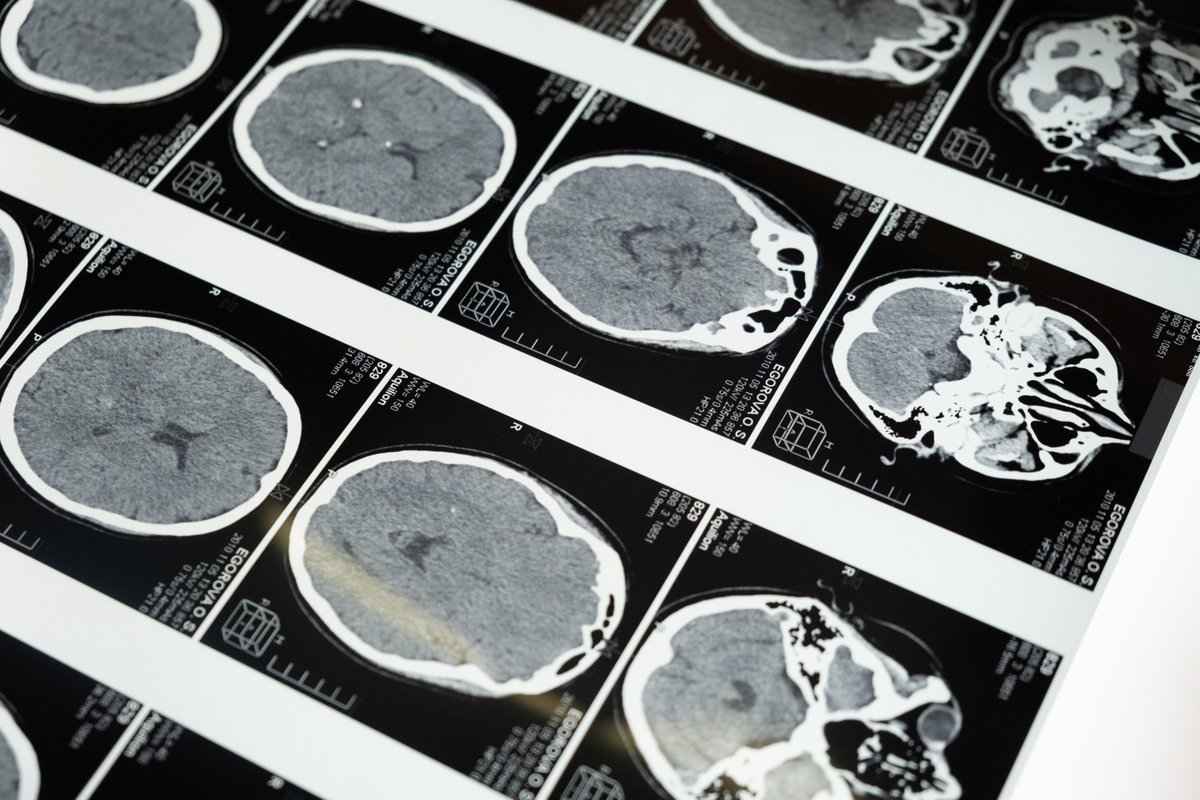 Elmedicoint's tweet photo. Ensayo STRATEGY I Analiza el papel del #tirofibán 💊 en el #ictus ateromatoso de ramas 🧠
Publicado en JAMA Neurology 🗞️
-
[Un contenido de EMI a través de Univadis] ⬇️
https://t.co/aZJgv23SOQ https://t.co/whs1zNlINb