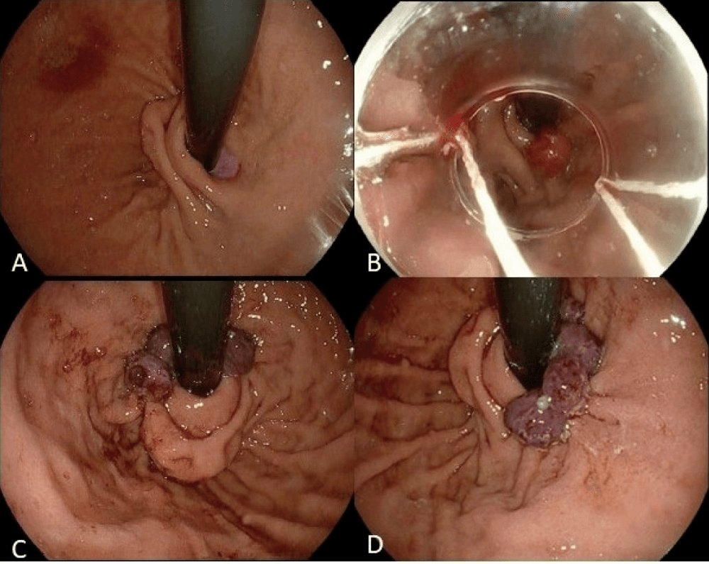 EndoCollabcom's tweet photo. Endoscopic GERD therapy, by mechanism:
 
Radiofrequency: Stretta
 
Plication: TIF (EsophyX, MUSE), GERDx
 
Resection: ARMS, ESD-G
 
Constriction: CLEAR band ligation
 
Ablation: ARMA
 
None is as established as laparoscopic fundoplication, and most have not been evaluated extensively.