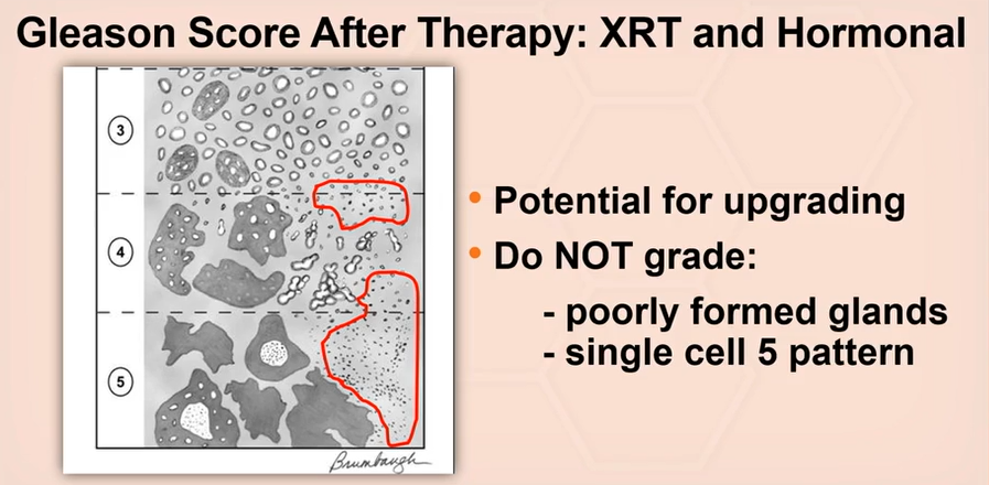 Janiranavarro's tweet photo. Prostate - Radiation or hormonal therapy can induce poorly formed glands.
Do not diagnose poorly formed glands or single-cell pattern 5 after therapy.
Cribriform glands and intraductal carcinoma can still be diagnosed, those are not treatment-induced.

Dr. McKenney. Prostatic Adenocarcinoma Grading: 2026 Update #USCAP #pathology #PathX
