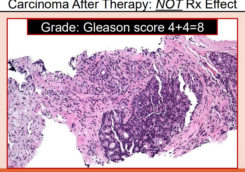 Janiranavarro's tweet photo. Prostate - Radiation or hormonal therapy can induce poorly formed glands.
Do not diagnose poorly formed glands or single-cell pattern 5 after therapy.
Cribriform glands and intraductal carcinoma can still be diagnosed, those are not treatment-induced.

Dr. McKenney. Prostatic Adenocarcinoma Grading: 2026 Update #USCAP #pathology #PathX