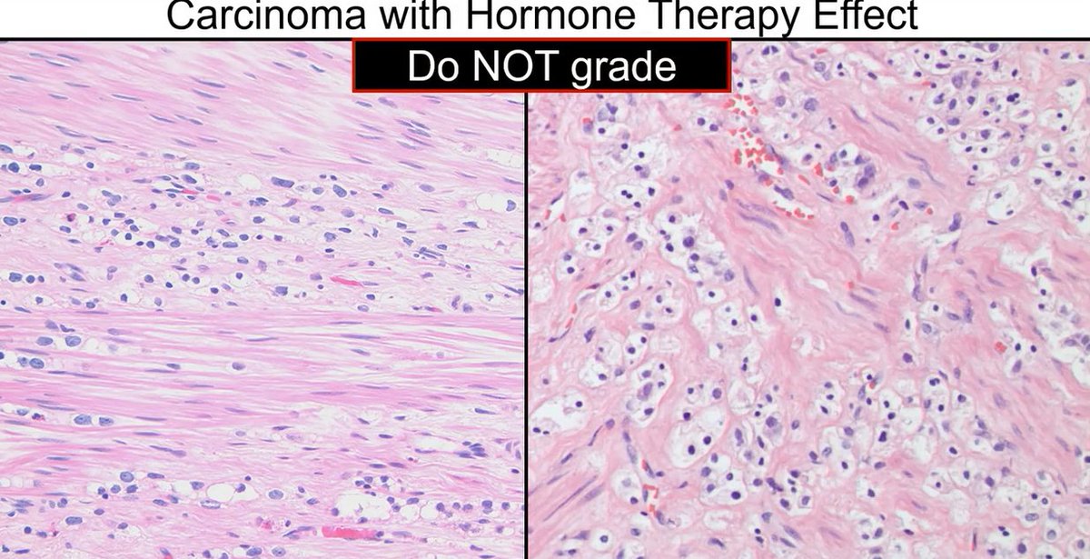 Janiranavarro's tweet photo. Prostate - Radiation or hormonal therapy can induce poorly formed glands.
Do not diagnose poorly formed glands or single-cell pattern 5 after therapy.
Cribriform glands and intraductal carcinoma can still be diagnosed, those are not treatment-induced.

Dr. McKenney. Prostatic Adenocarcinoma Grading: 2026 Update #USCAP #pathology #PathX