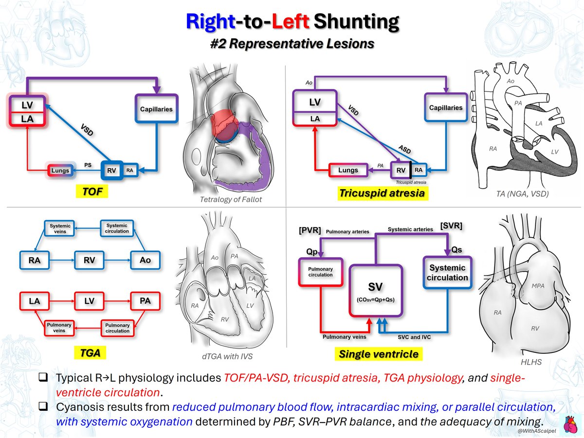 WithAScalpel's tweet photo. Right-to-Left Shunting: Physiology and Representative Lesions

👉Right-to-left shunting allows systemic venous blood to bypass effective pulmonary oxygenation, causing arterial desaturation and cyanosis.
👉In TOF/PA-VSD and tricuspid atresia, systemic oxygenation depends largely on pulmonary blood flow and the degree of intracardiac mixing.
👉TGA creates parallel circulations, while single-ventricle physiology depends on effective mixing and the balance between Qp and Qs.