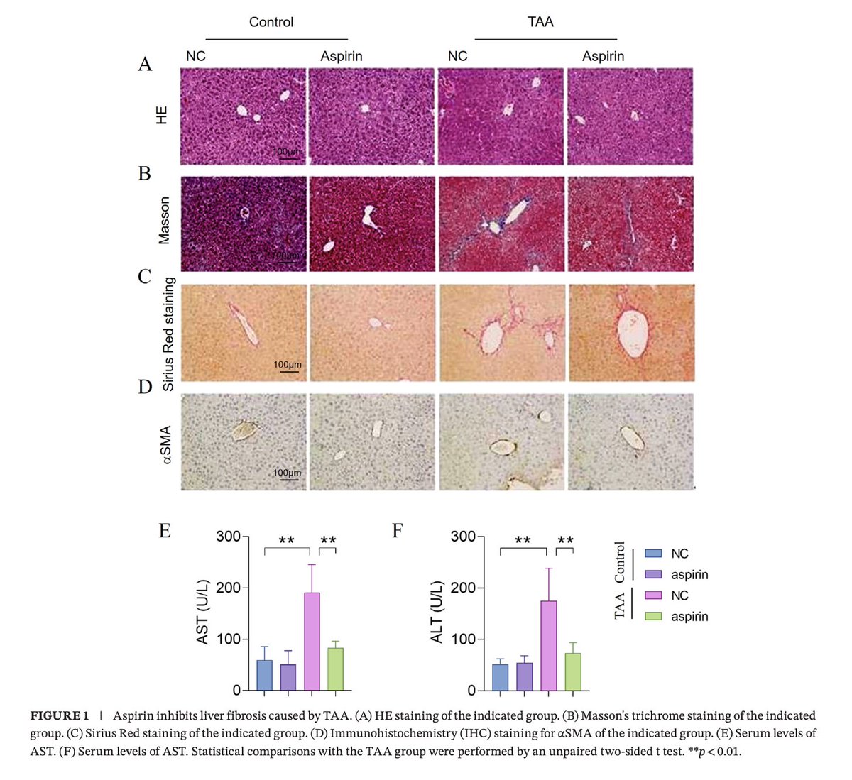 Outdoctrination's tweet photo. Aspirin actually prevents liver damage in experiments, by stimulating autophagy.

Unlike other NSAIDs, aspirin completely prevented:

➜ Liver scarring (fibrosis) 
➜ Rise in liver enzymes (ALT, AST)

This is in part because aspirin's metabolite salicylic acid helps activate autophagy initiating proteins.