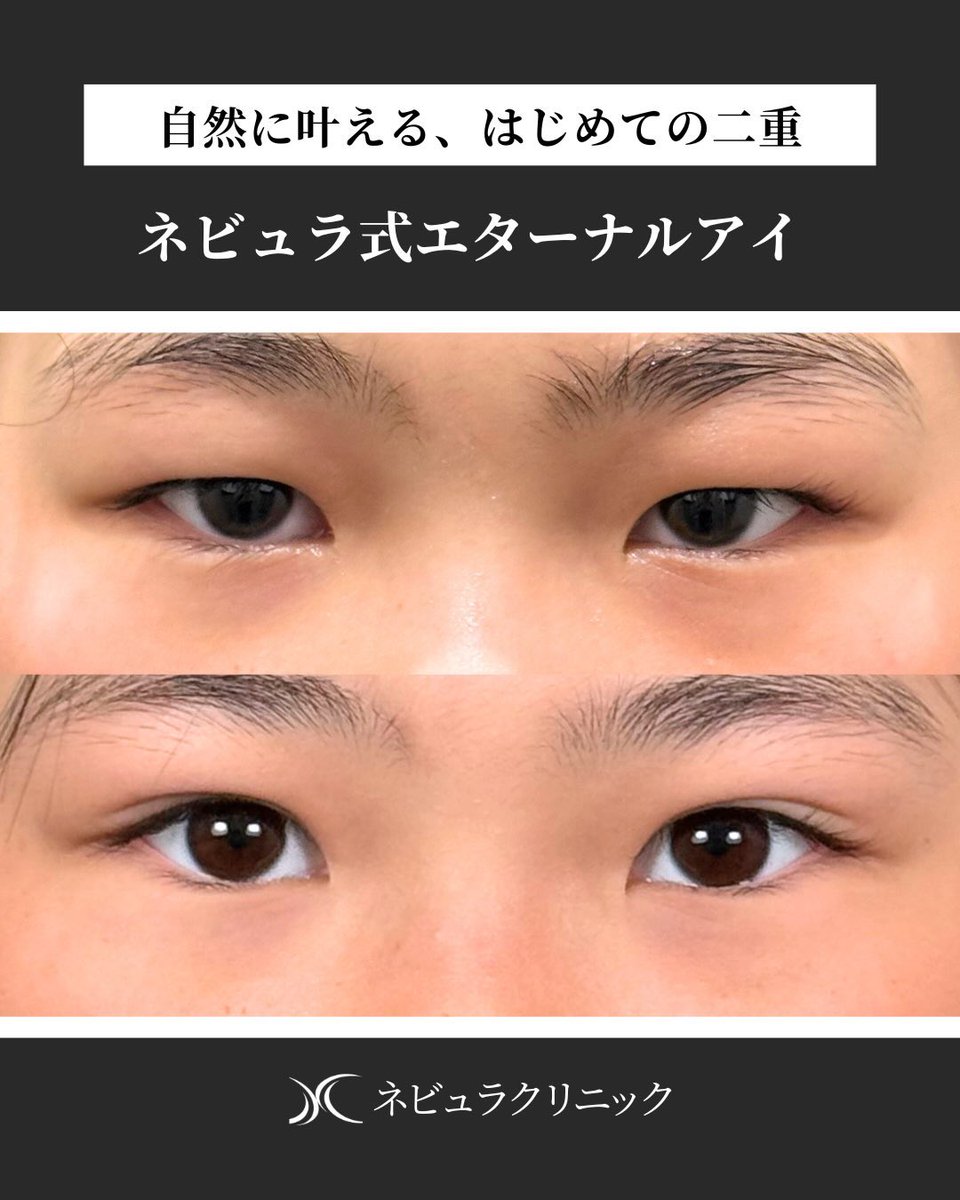 aichi_nebula's tweet photo. ◾️二重埋没症例

重たい目元を改善させたいとの事でご相談頂いた患者様。脂肪が多めの目元でしたが、脂肪取りはせずに固定力の高い手法で二重を形��。
術後はナチュラルにぱっちりとした目元に変わりました。

#二重埋没 #愛知美容外科 https://t.co/HGrKt5uS8t