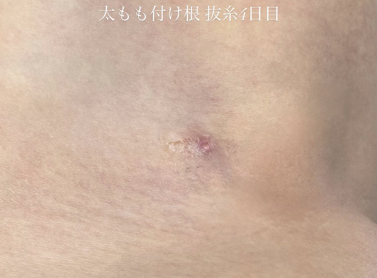 Ylrvn3's tweet photo. DT11日目🥧
・毎日食トレ過ぎてお腹ぷよぷよになってきたからジム行きたいけどまだ早いかなと思ってとりあえずウォーキング30分だけ🥶
・(3枚目)抜糸後の傷痕が綺麗過ぎてびっくり✨
保湿&amp;テープちゃんとやってもっと綺麗に治るように頑張ろう✊🏻💗 https://t.co/tmAfFjW4Km