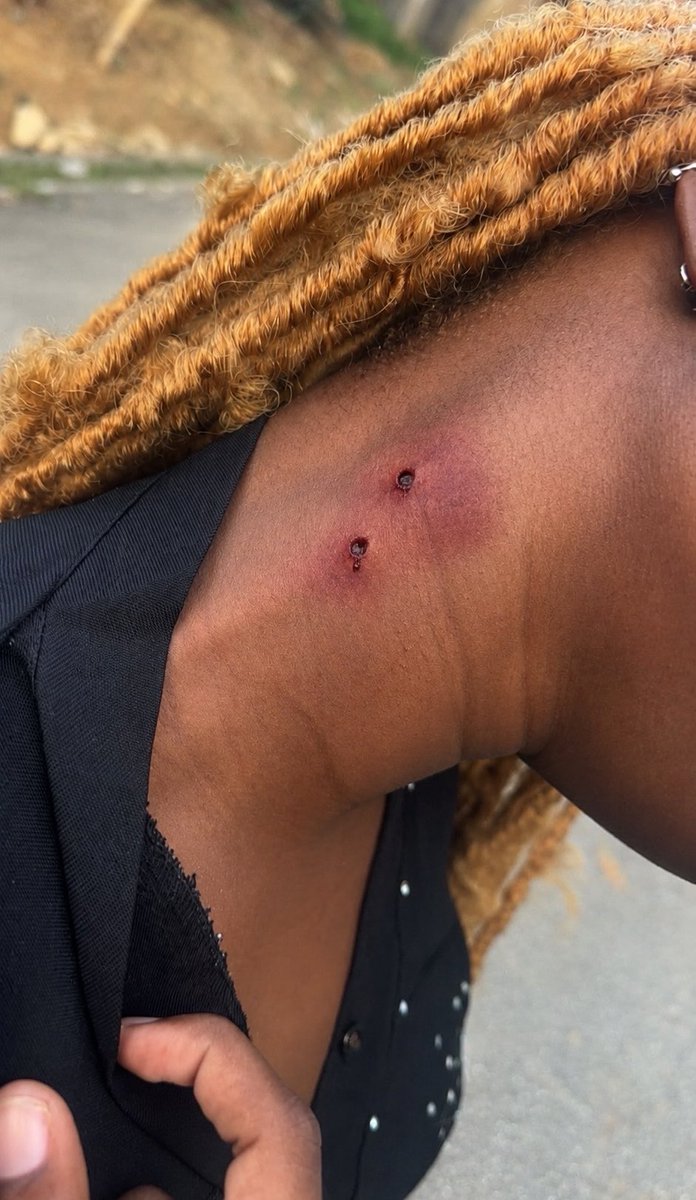 Lolaschanne's tweet photo. This hickey no gree heal o😭
What can I do? https://t.co/sypsaE2QY8