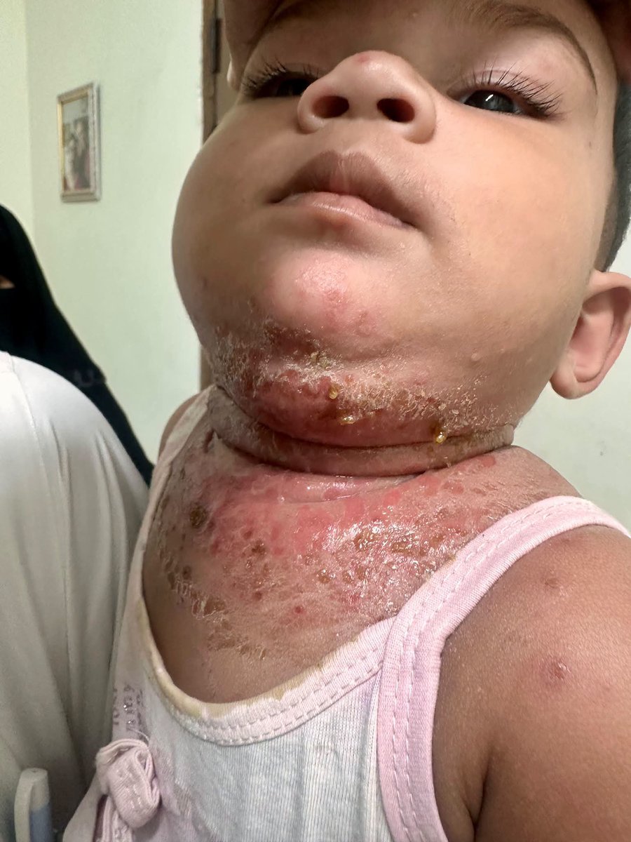 keith_bishop_'s tweet photo. A 1-year-old child with no history of atopy presents with erythematous lesions with honey-colored crusts and oozing, involving the chin, neck, and upper chest.
🔎 What is the most likely diagnosis?
A) Impetigo
B) Atopic dermatitis with secondary bacterial infection
C) Eczema herpeticum
D) Allergic contact dermatitis
E) Periorificial dermatitis
F) Acrodermatitis enteropathica