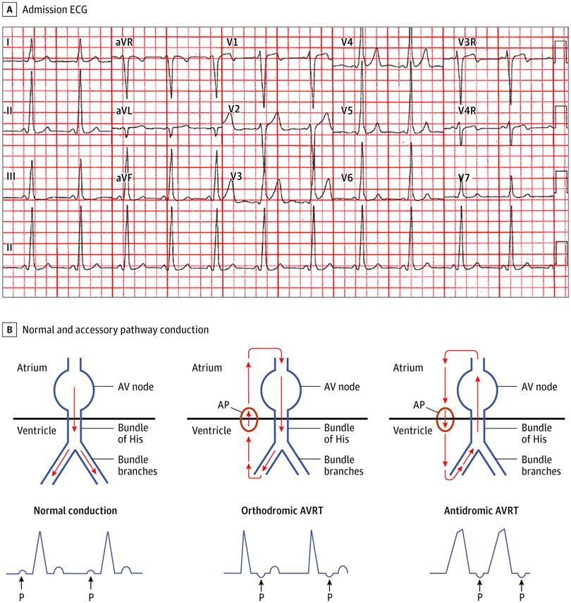 HiraaliCardio's tweet photo. Ventricular Pre-excitation found in Patient with WPW syndrome https://t.co/VCh1K08ADV