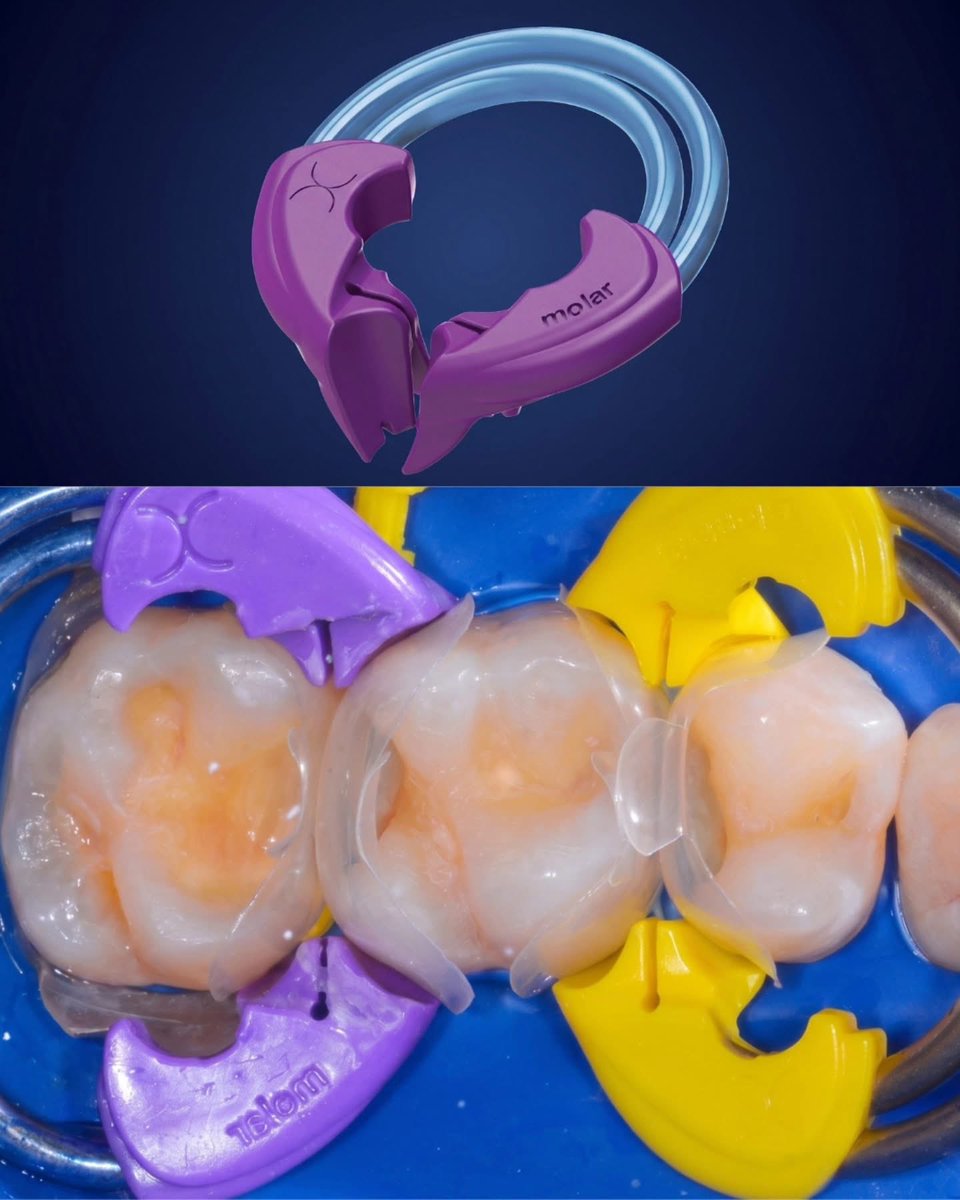 drAnasabdo's tweet photo. •Bioclear Matrix with Adaptive Ring 
•تصميم فريد.

Courtesy:Dental Art

#endo_prostho_ortho
#EPO
#DrABDO
•You can ask …!!

•follow me: https://t.co/Cx1MjDfBjG