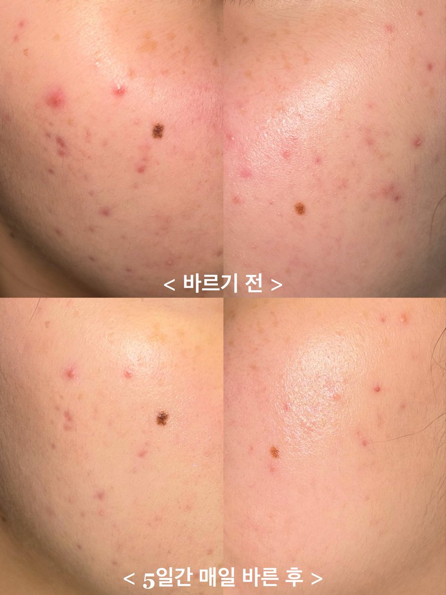 ta1k1ngt0myse1f's tweet photo. #광고 #RT_이벤트 

매번 제 엉망 피부를 책임지고 살려내주는 에쿠와에서 크림이 새롭게 출시됐어요📣📣

스킨케어 맛집 답게 이번 신상도 대박🥹

#RT + @aequwa 계정 팔로우하시면 추첨으로 5️⃣ 분께 에쿠와 아줄렌 크림 본품 보내드립니다💜

홍조 / 여드름 / 모낭염 피부는 에쿠와 제품 일단 쟁여두세요 (공익제보)

트러블 케어 효과에 발림성까지 갖춘!! 기특한 아이🥺🫳🫳

B/A 사진 보정 있을 시 죽음