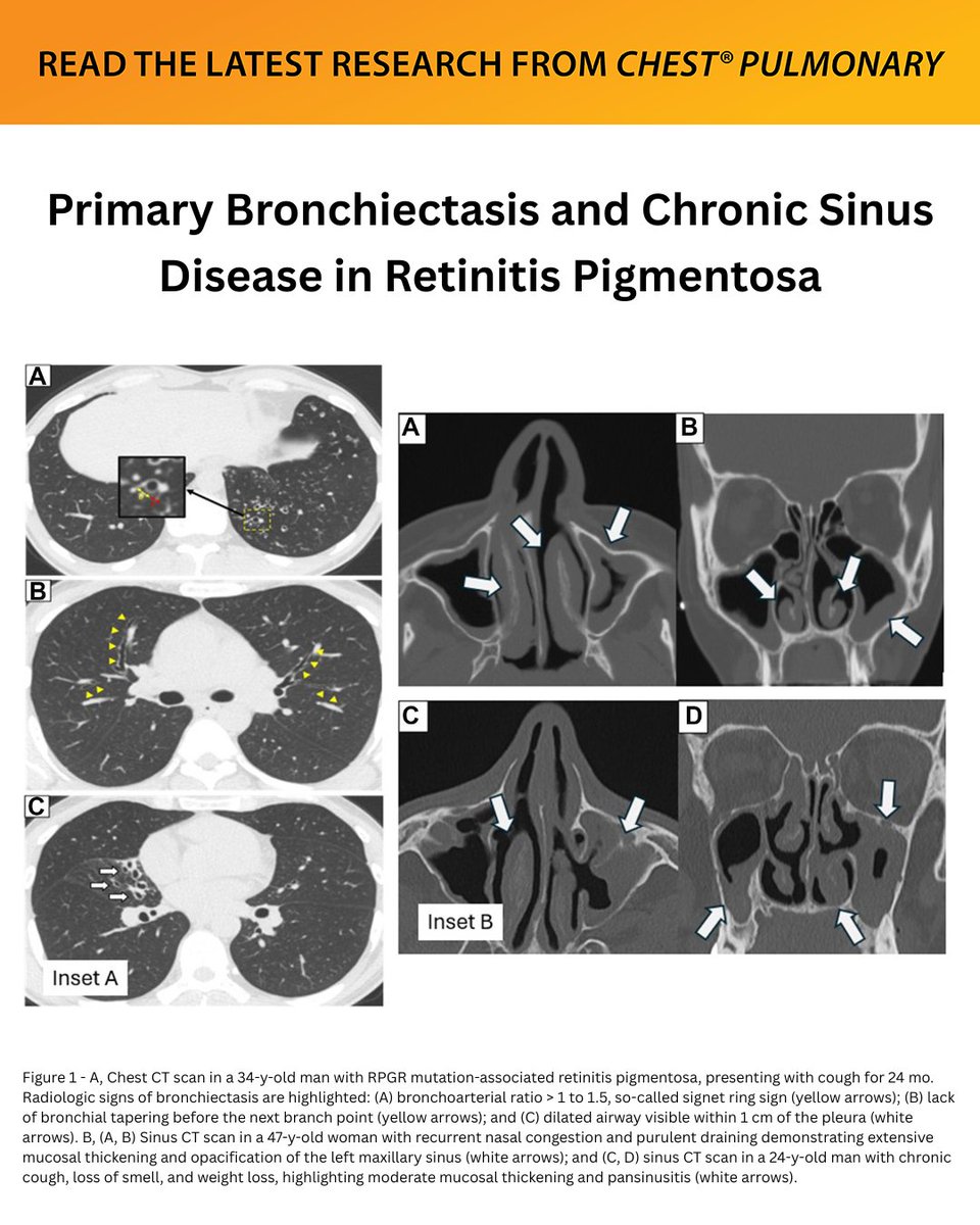 journal_CHEST's tweet photo. A #Journal_CHESTPulm research letter aimed to systematically assess the background clinical and radiologic prevalence of primary bronchiectasis and chronic sinus disease in patients with retinitis pigmentosa.
Read the article: https://t.co/PPCkA30iYx
#MedEd #JournalCHEST https://t.co/xVHiSlM8ZB