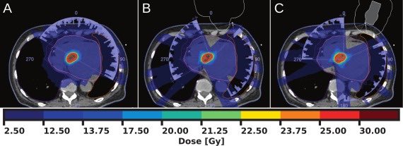 to_be_elizabeth's tweet photo. 📌 Integration of an echocardiographic motion-management system into photon-based stereotactic arrhythmia radioablation planning

🔗 https://t.co/DqgnUJXGDE
@OncoAlert #OncoAlertAF @UniHeidelberg 

Happy to share our latest research⚡️🫀

☢️ Photon-based #STAR planning with an ultrasound probe is feasible. 🔹D0.035 cm3 to the probe below 1 Gy with apical/ parasternal probe placement. 🔹No significant differences in target dose-volume metrics with spared probe. 🔹All dose guidance parameters within clinically acceptable limits. 🔹Results support further investigation of ultrasound-based motion management.