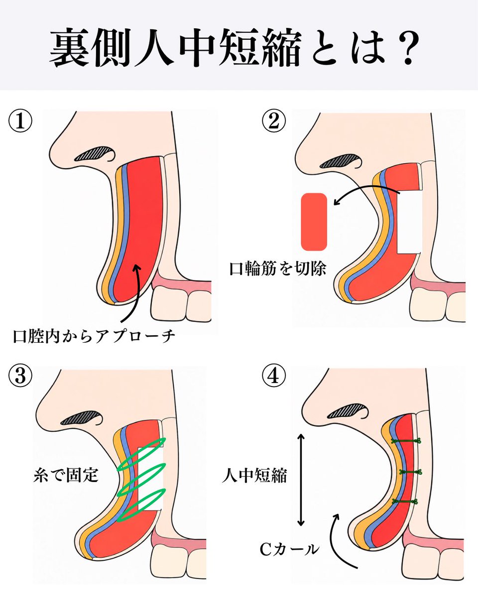dr_murayamafu's tweet photo. Cカール形成術（裏側人中短縮）とは？

Cカール形成（裏側人中短縮）は
・上唇の裏側を切開してアプローチ
・口輪筋と呼ばれる人中部分の筋肉を切除
・皮膚の裏側と骨膜を糸で固定
→人中の中心部分に窪みを作ることで、上唇がカールし、自然に人中が短くなります。

院長の山本あきよし先生@dr_y_akiyoshi に先日、Cカール形成を行い1ヶ月半経過しました！

基本的に筋肉の切除と皮下の固定を行っているので、癒着を起こせば半永久的な効果になります。
また人中のもっこり感が気になる方、笑った時に歯が見えすぎてしまう方にも良い適応です！

ちなみに引用元で村山“史郎“とありますが、史郎ではなく史朗（ふみあき）と言います！