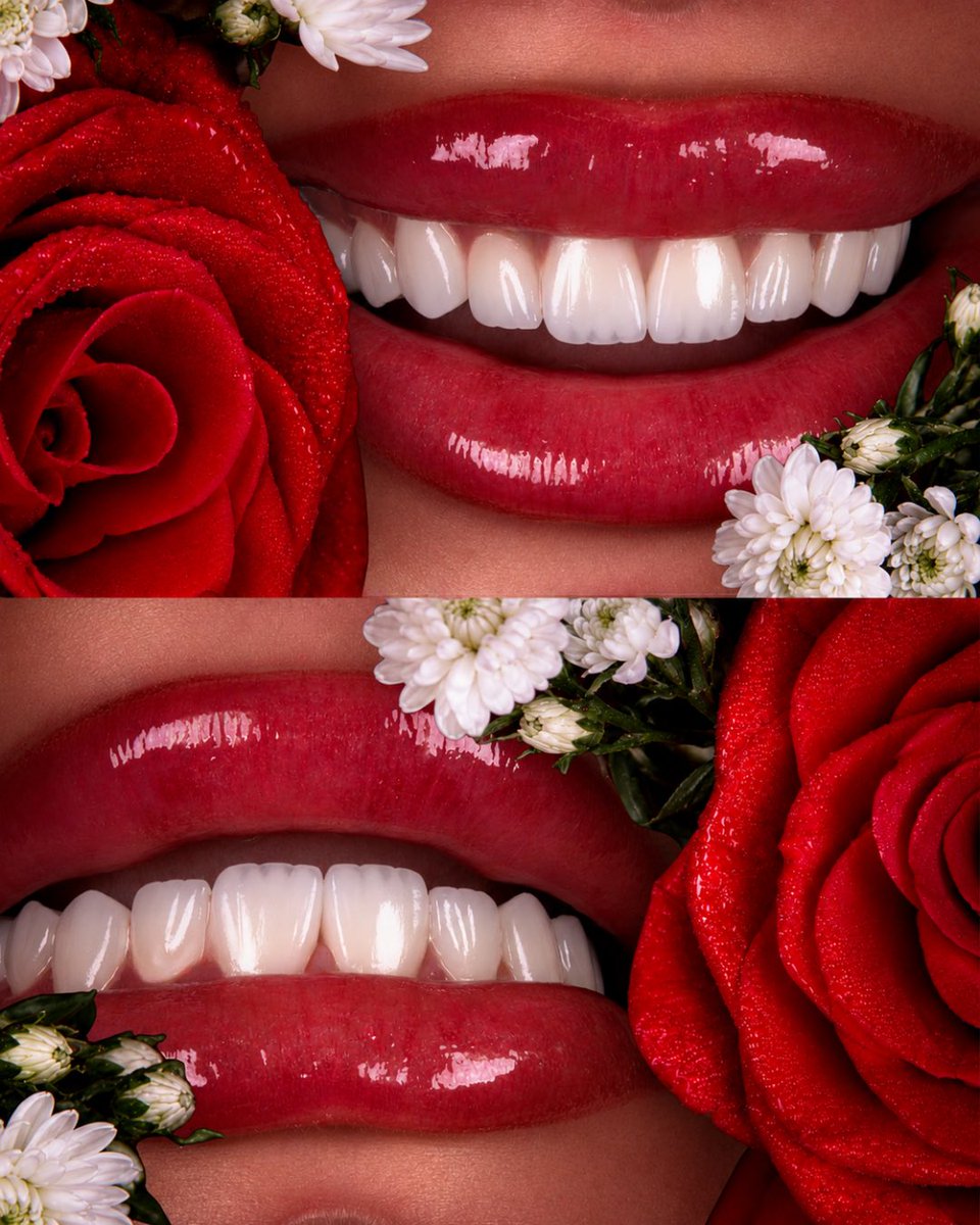 drhalmuhaisen's tweet photo. ابتسامة مثل الوردة 🌹
#Dentistry #DentalCare #Dentist #SmileMakeover #CosmeticDentistry #DentalClinic #OralHealth #HealthySmile #PerfectSmile #DentalAesthetics #Veneers #TeethWhitening #DentalImplants #AmmanDentist #JordanDentist #Amman #Jordan #SmileDesign #DigitalSmileDesign https://t.co/YkaunarRsN