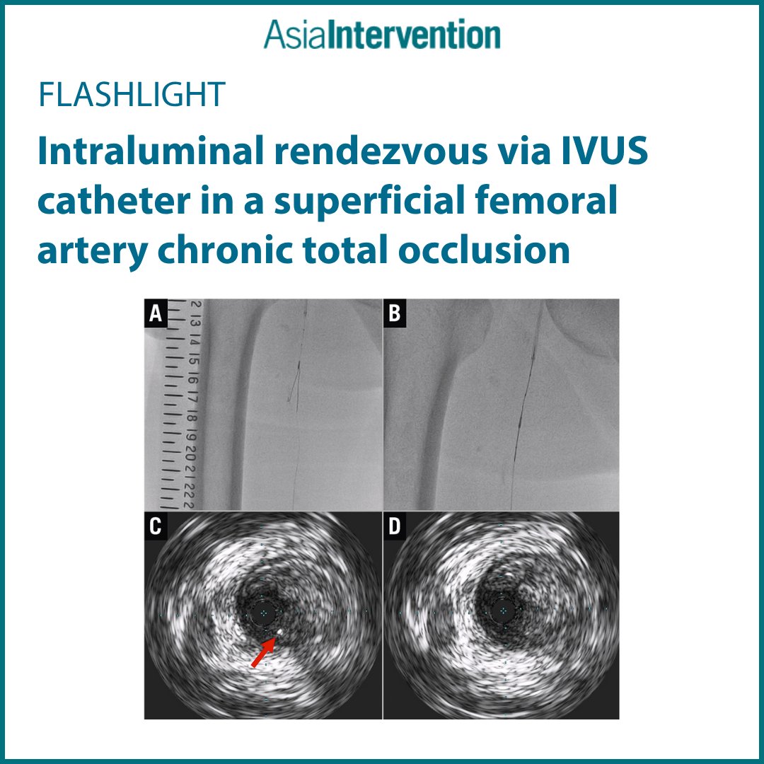 AsiaInterv's tweet photo. 🔍 How can #IVUS help achieve wire externalisation in a long SFA #CTO?
This case presents a novel intraluminal rendezvous technique using an IVUS catheter to guide the retrograde wire.
🔗https://t.co/Zh7yu4stEI https://t.co/s3st4ERfVj