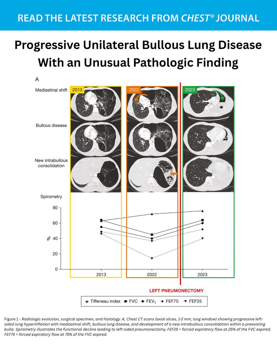 journal_CHEST's tweet photo. Progressive Unilateral Bullous Lung Disease With an Unusual Pathologic Finding
What's the diagnosis? Read the full article in the September issue of the journal CHEST®: https://t.co/1hu6eU2c2A
#MedEd #JournalCHEST https://t.co/gT28DamfMC