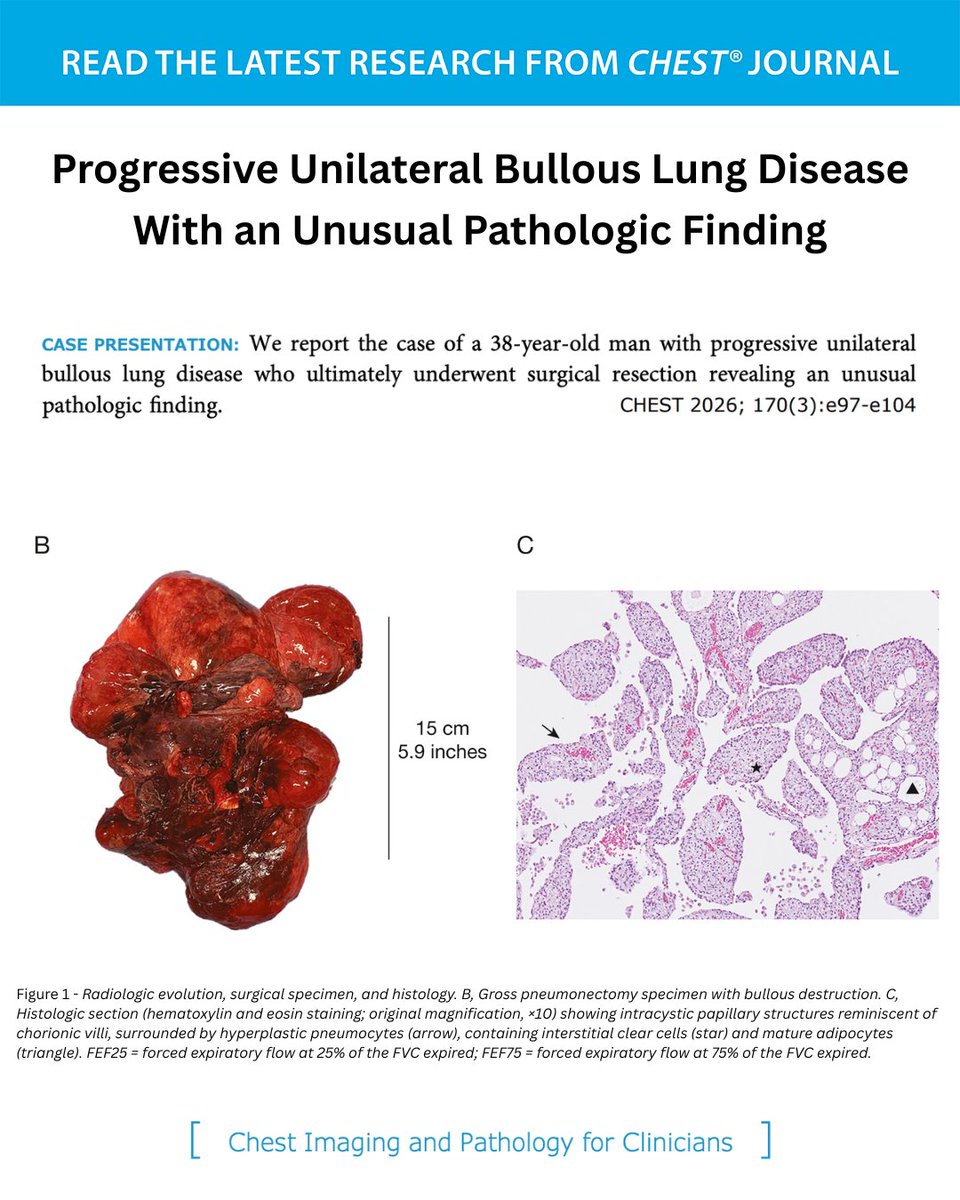 accpchest's tweet photo. Progressive Unilateral Bullous Lung Disease With an Unusual Pathologic Finding
What's the diagnosis? Read the full article in the September issue of the journal CHEST®: https://t.co/383kDaFMhJ
#MedEd #JournalCHEST https://t.co/ySLRqoFucy