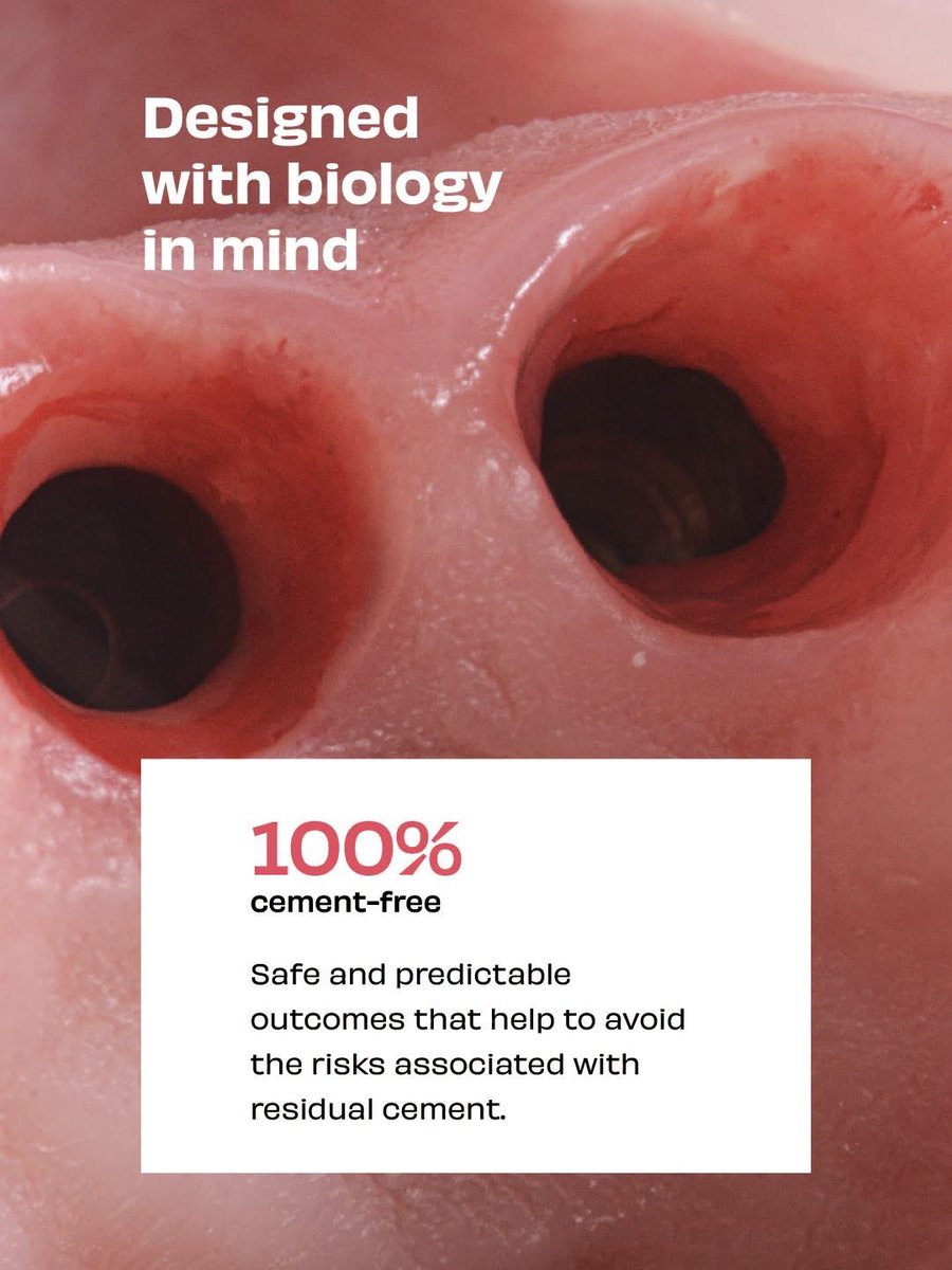 drAnasabdo's tweet photo. •Procera, Nobel biocare 
•تصميم فريد.

Courtesy:Nobel Biocare

#endo_prostho_ortho
#EPO
#DrABDO
•You can ask …!!

•follow me:
#ridgepreservation #socketpreservation #bonegraft #xenograft #autogenousbone #oralsurgery #implantdentistry #periodontics https://t.co/diuQdT5lSp