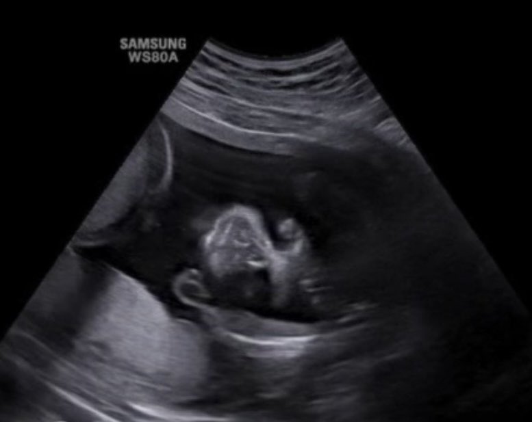 CaliAggy's tweet photo. can't believe I'm bringing another Dominican and Haitian boy to this crazy world ✝️👶🏽
Our baby is looking soooo handsome already! With a head full of HAIR! God, I'm so ready to meet him M.M 🥹🧡
12.25.26 https://t.co/A6RyRJUF5E
