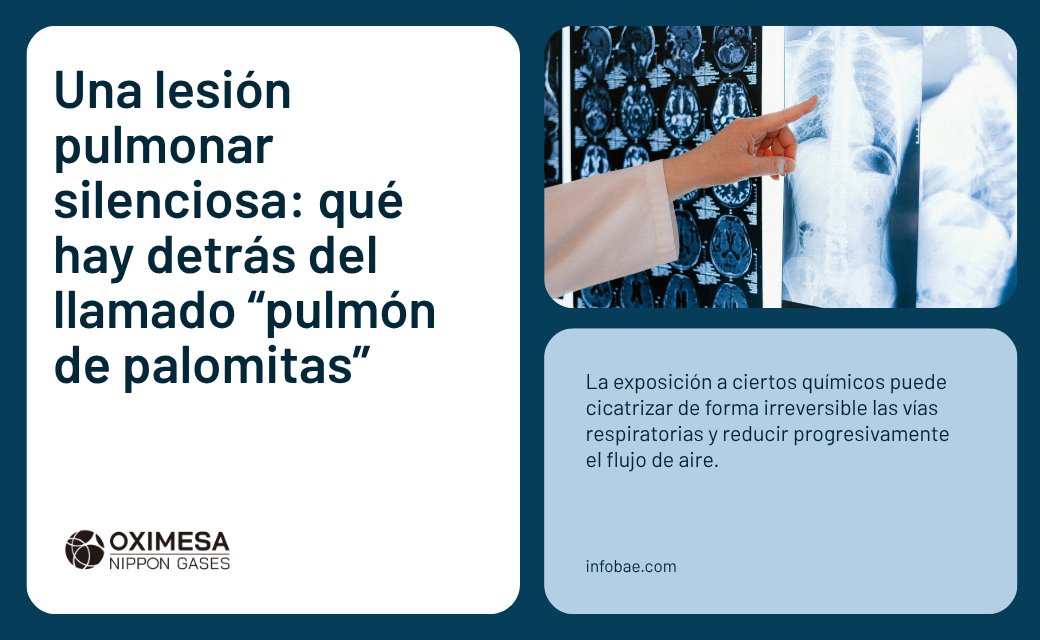 OximesaNG_TRD's tweet photo. 🍿El “pulmón de palomitas de maíz” es una #enfermedad rara que cicatriza y estrecha las vías respiratorias
Puede causar tos seca y falta de aire, y se ha relacionado con la inhalación de sustancias químicas presentes en algunos #vapeadores
📎 @infobae
https://t.co/a0z4PKk8TT https://t.co/jRabv0Whv8