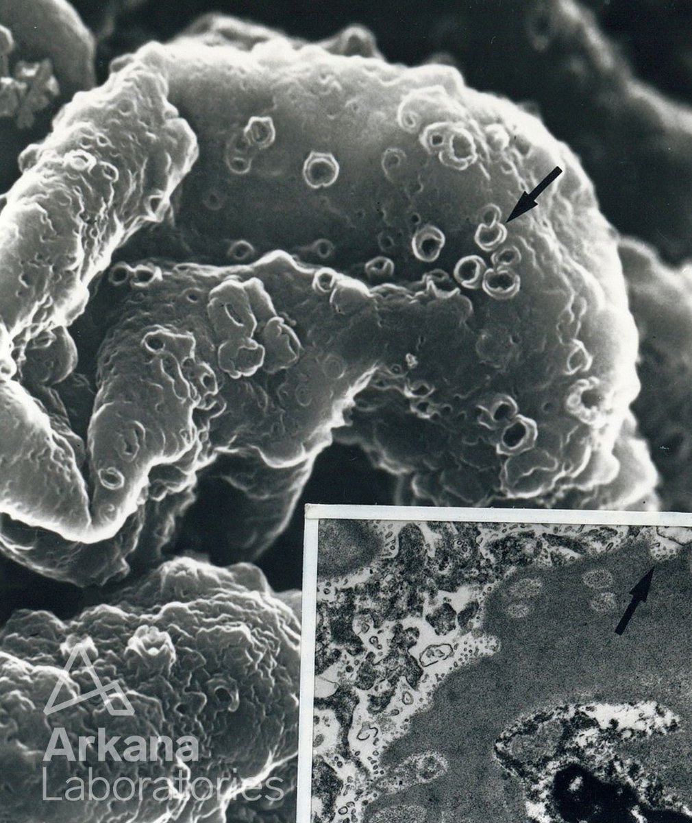 arkanalabs's tweet photo. Here is today’s #eyeSCANdy! Acellular SEM of membranous GN, stage IV. Note the distinct craters and circular orifices of the incompletely bridged reticular BM. Inset: TEM showing thickened GBM with discrete crater (arrow) and partially bridged and resorbed deposits.
Photo courtesy of Dr. Stephen Bonsib. #renal #pathology #kidneypath