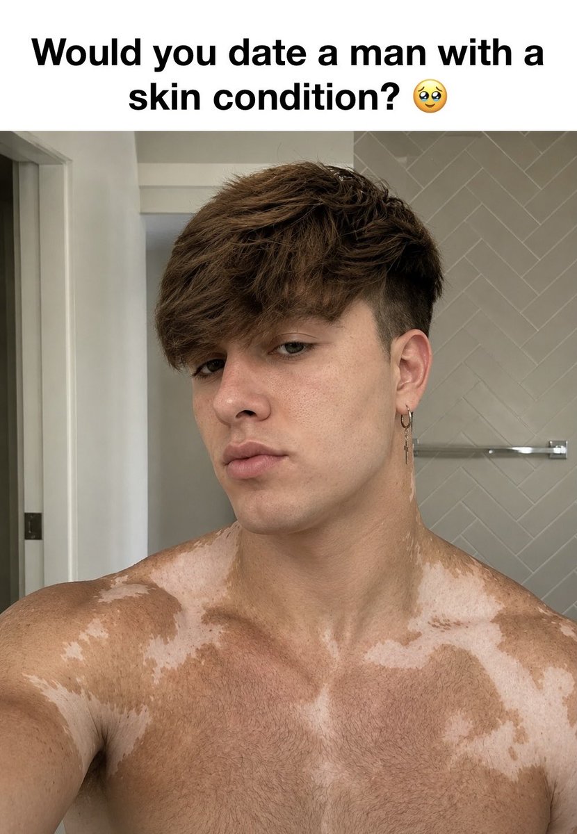 SoftGayLove's tweet photo. I've dated someone with eczema before, and I would sometimes notice him getting insecure about it, but it never really bothered me. https://t.co/EeLIKFzOsI