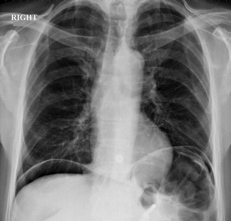 RadMasterclass's tweet photo. X-RAY QUIZ: Acute abdominal pain. What would you do next?
A: Place an abdominal drain
B: Request abdominal ultrasound
C: Request abdominal MRI
D: Resuscitate the patient and inform the surgeons
E: Take a break 
Start Quiz https://t.co/mgvgKXJC0i https://t.co/LQChko8hAS