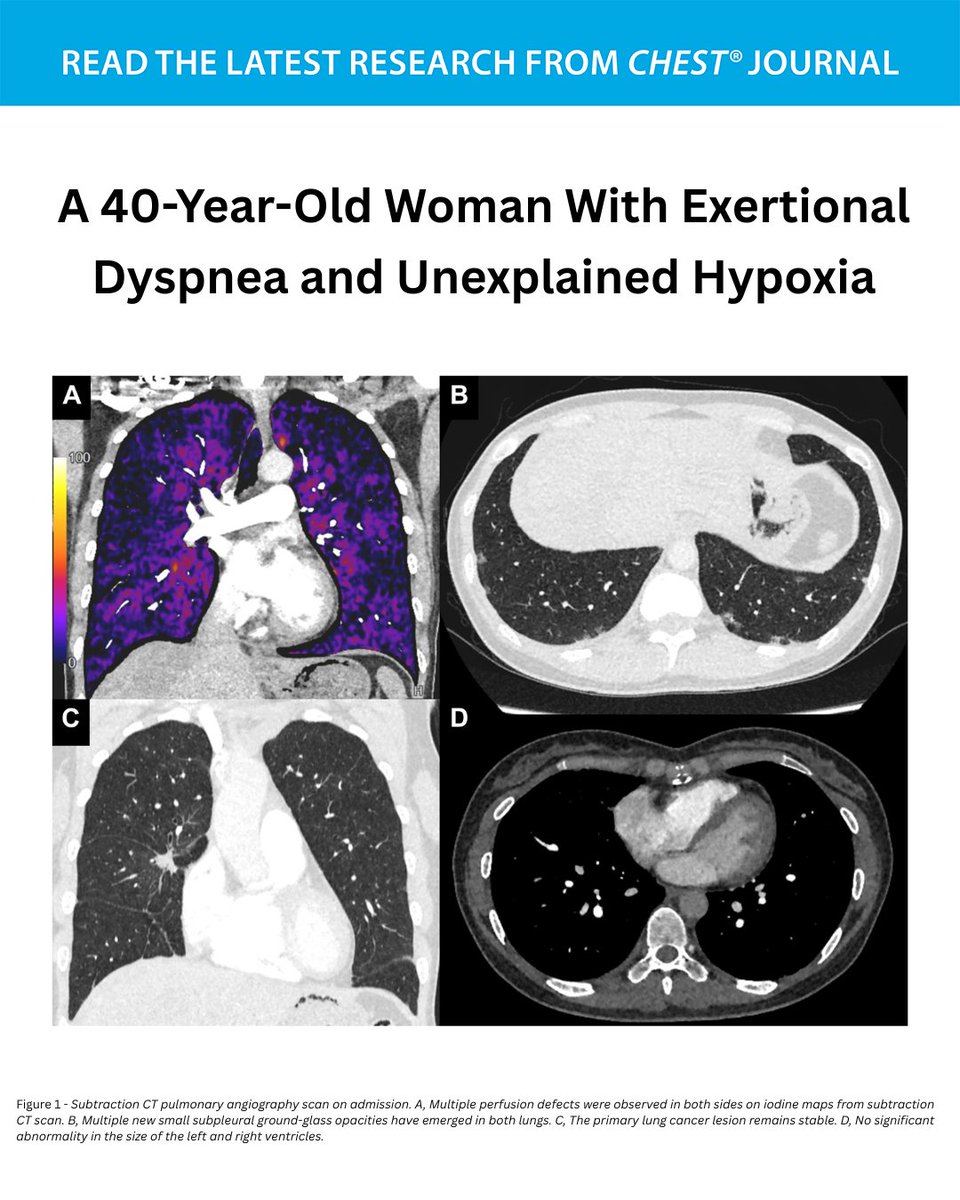 accpchest's tweet photo. A 40-Year-Old Woman With Exertional Dyspnea and Unexplained Hypoxia
What's the diagnosis? Read the full CHEST Pearl in the September issue of the journal CHEST®: https://t.co/56alBUK3B7
#MedEd #JournalCHEST https://t.co/7dzreD2lVZ